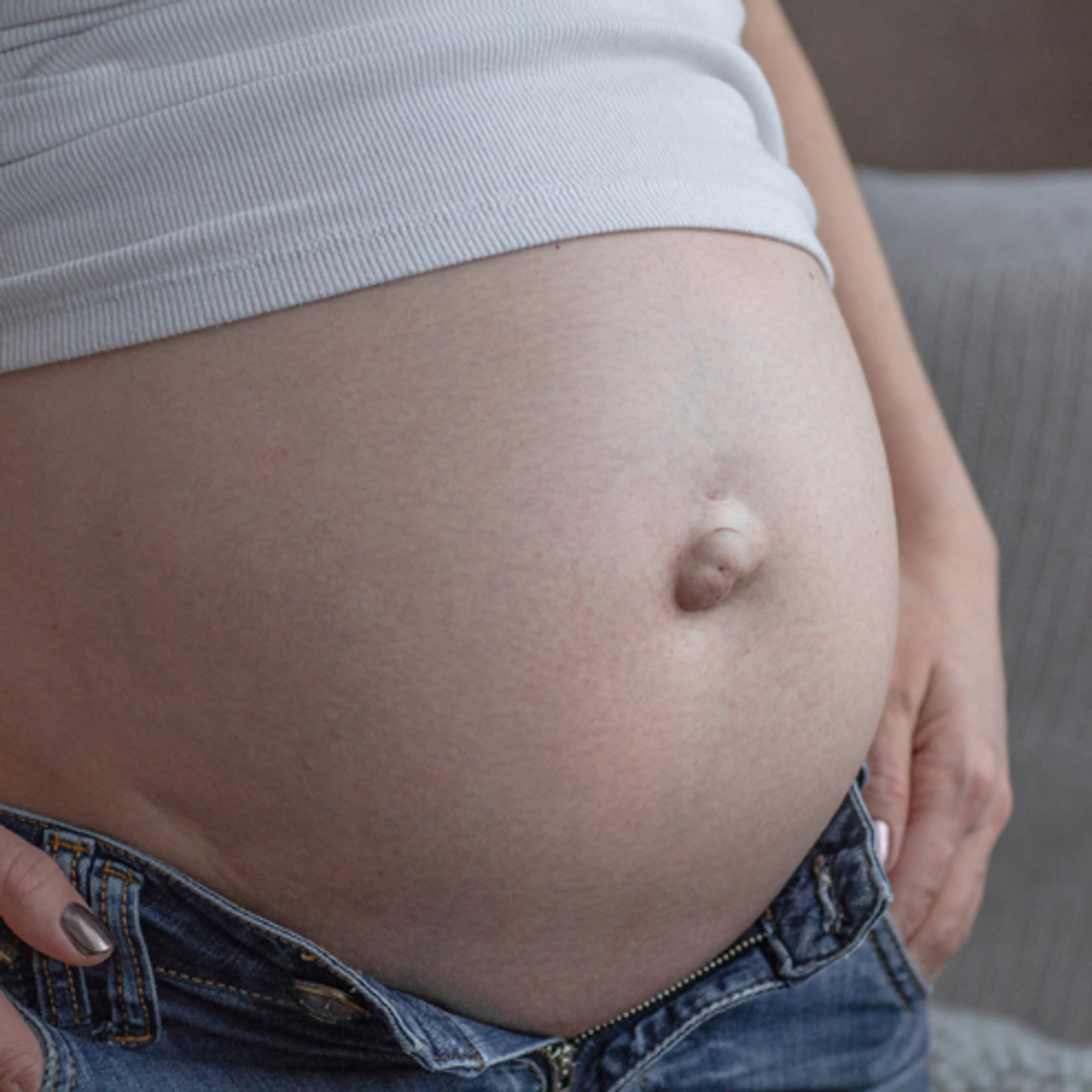 Umbilical hernia