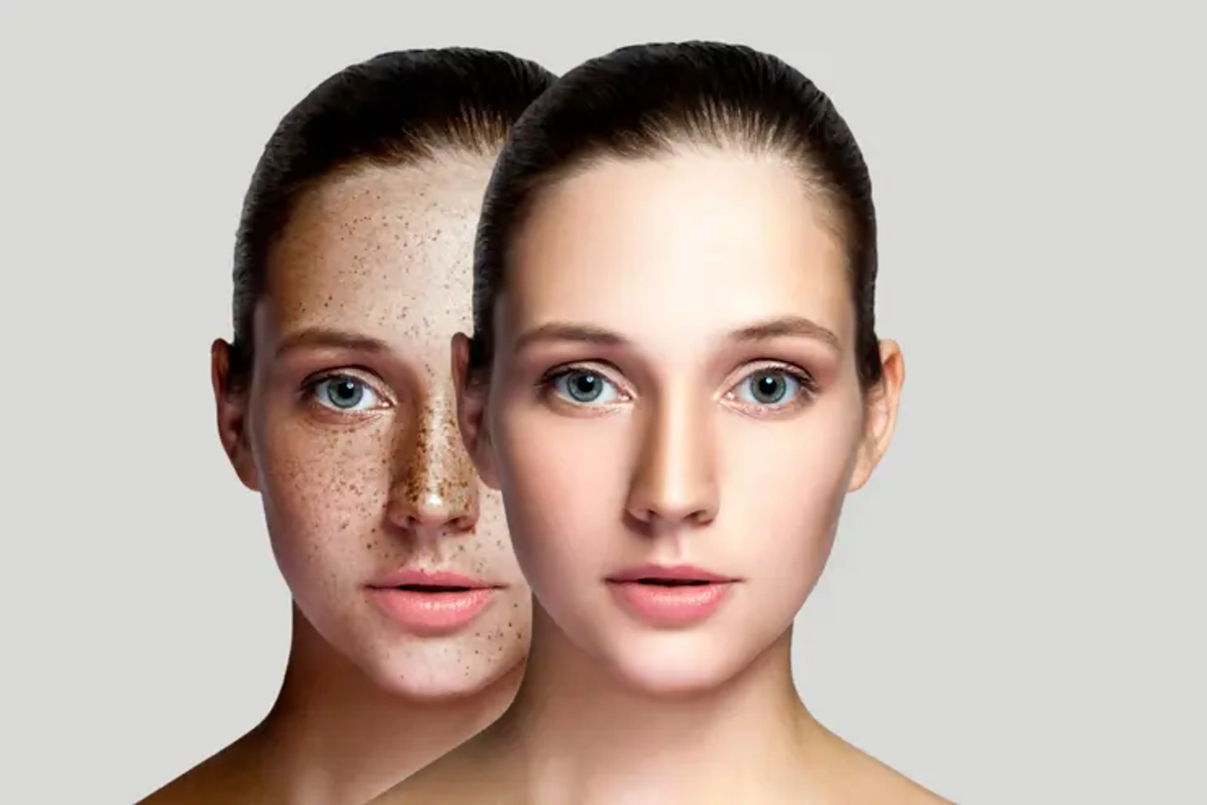 Multi whitening treatment results showing improved skin brightness, reduced hyperpigmentation, lightened freckles, and overall even skin tone enhancement.