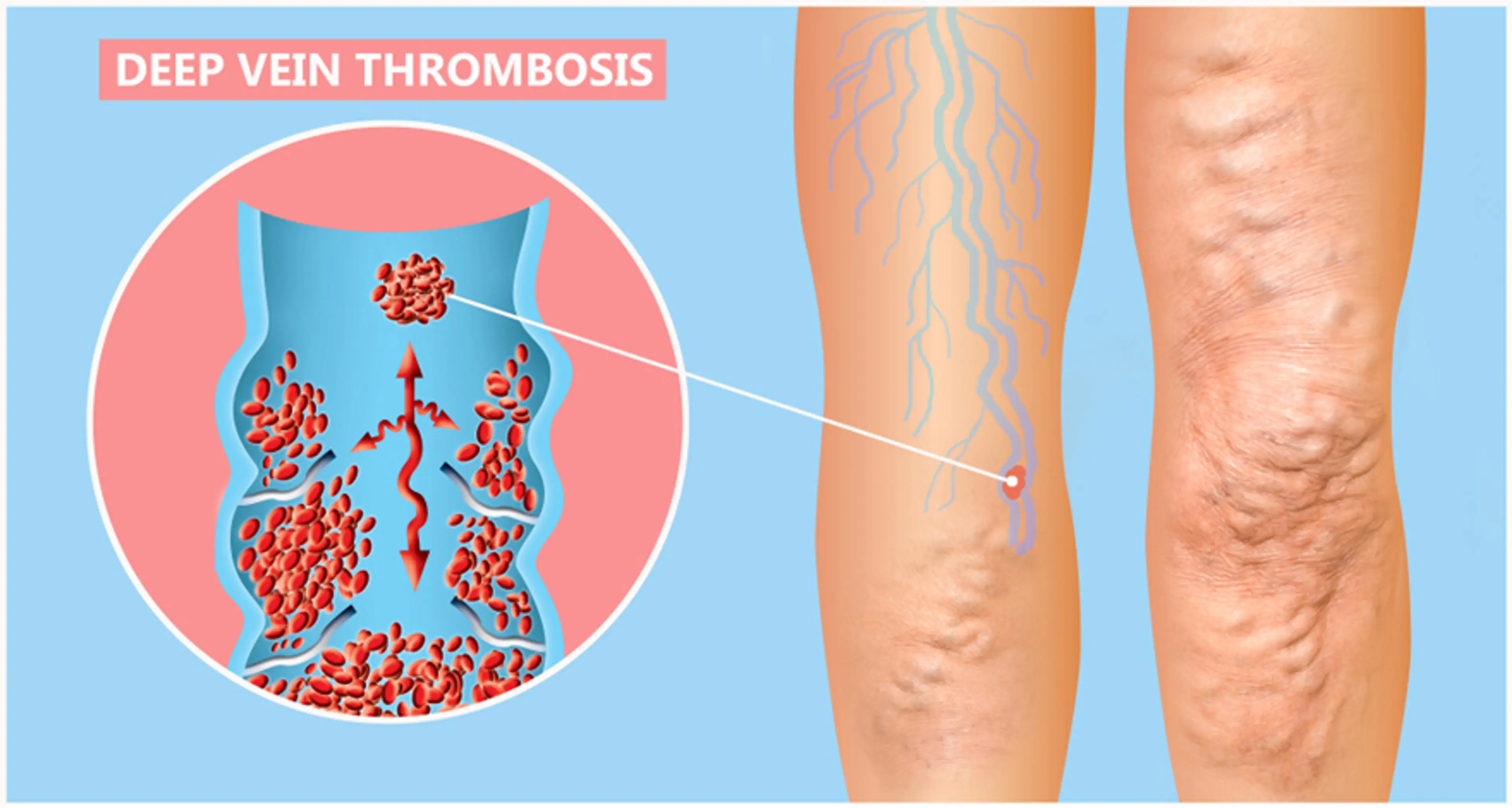 Deep Vein Thrombosis