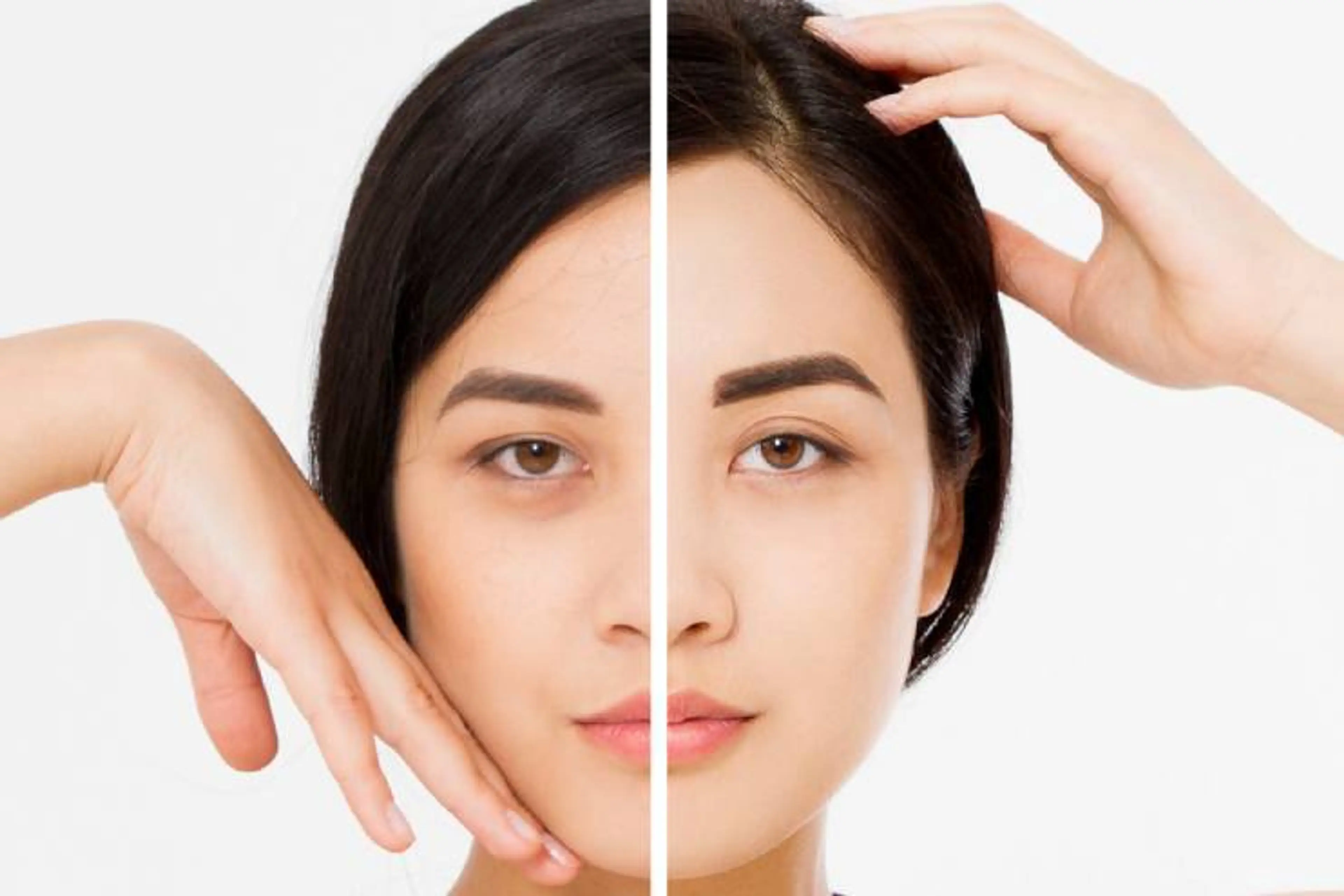 Brow Lift