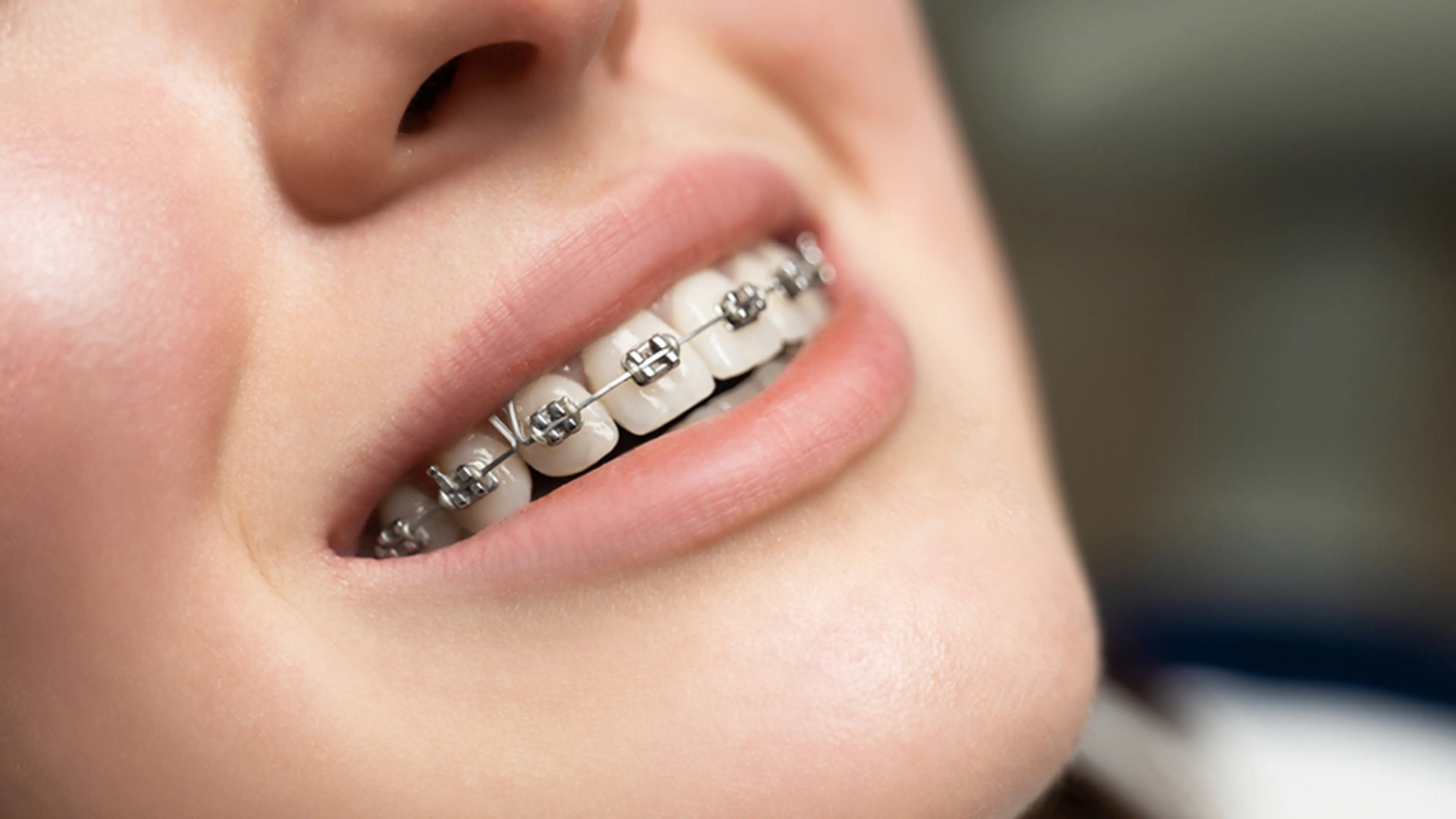 Orthodontic Treatment and Braces
