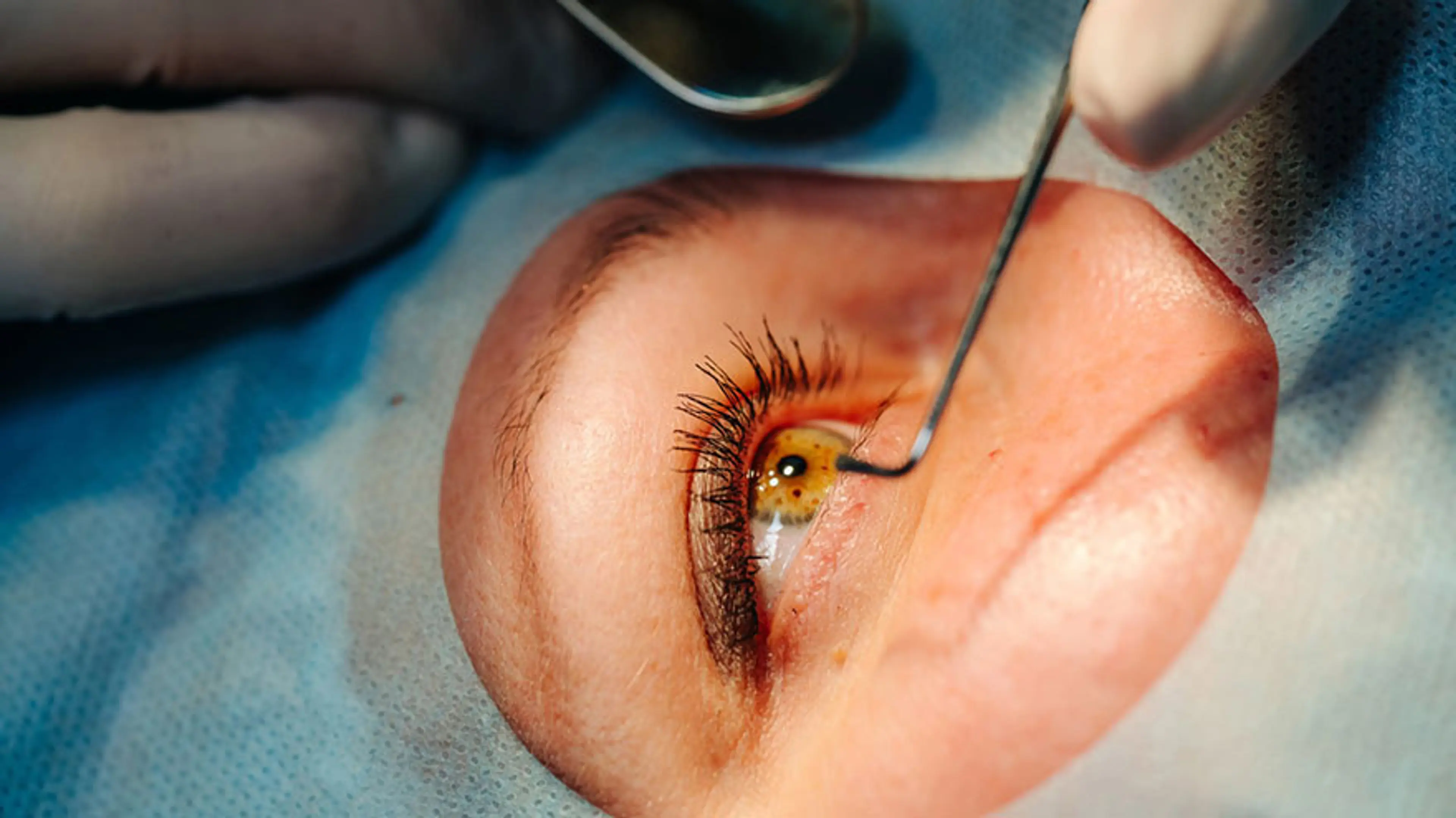 Cheap LASIK