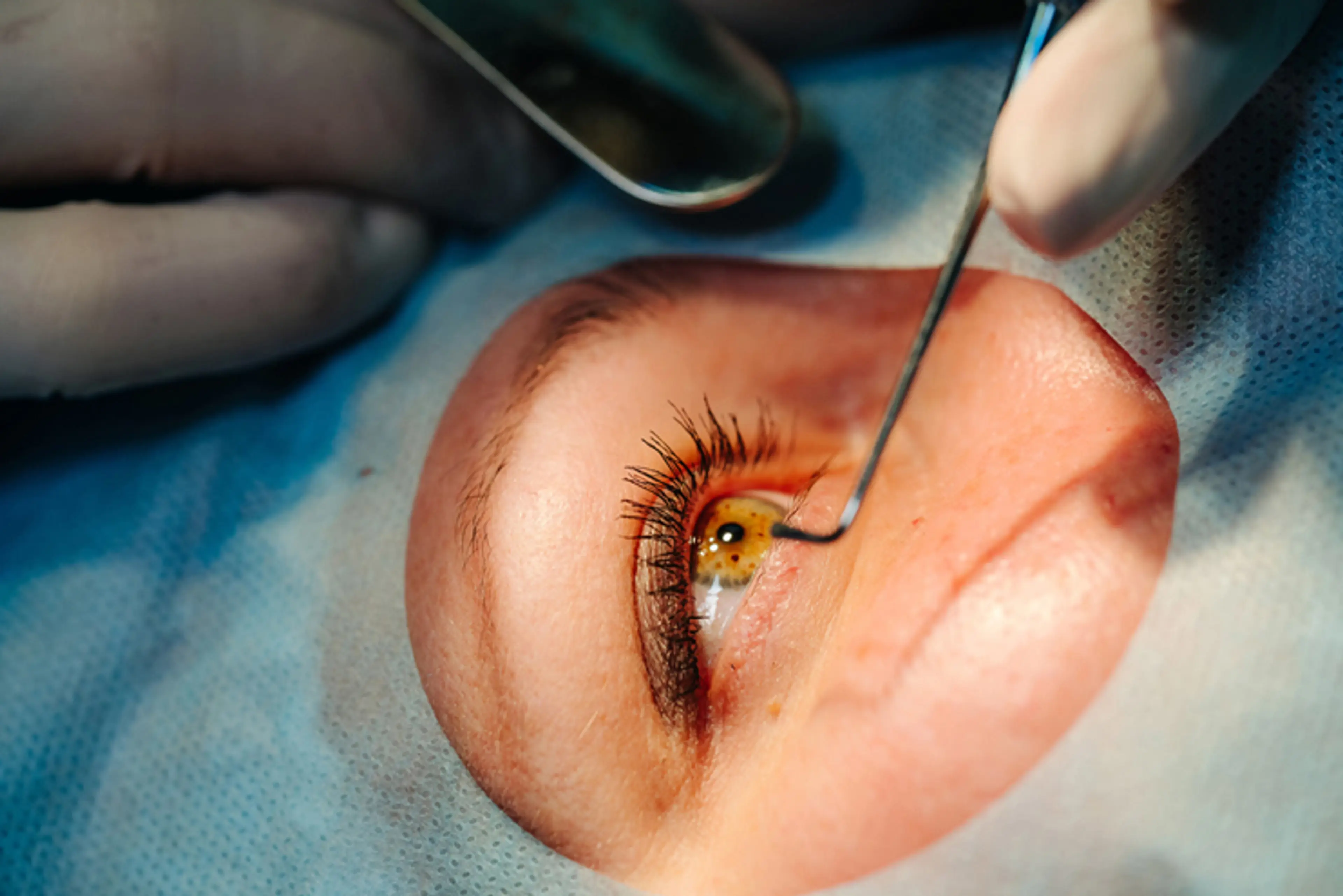 Cataract Surgery