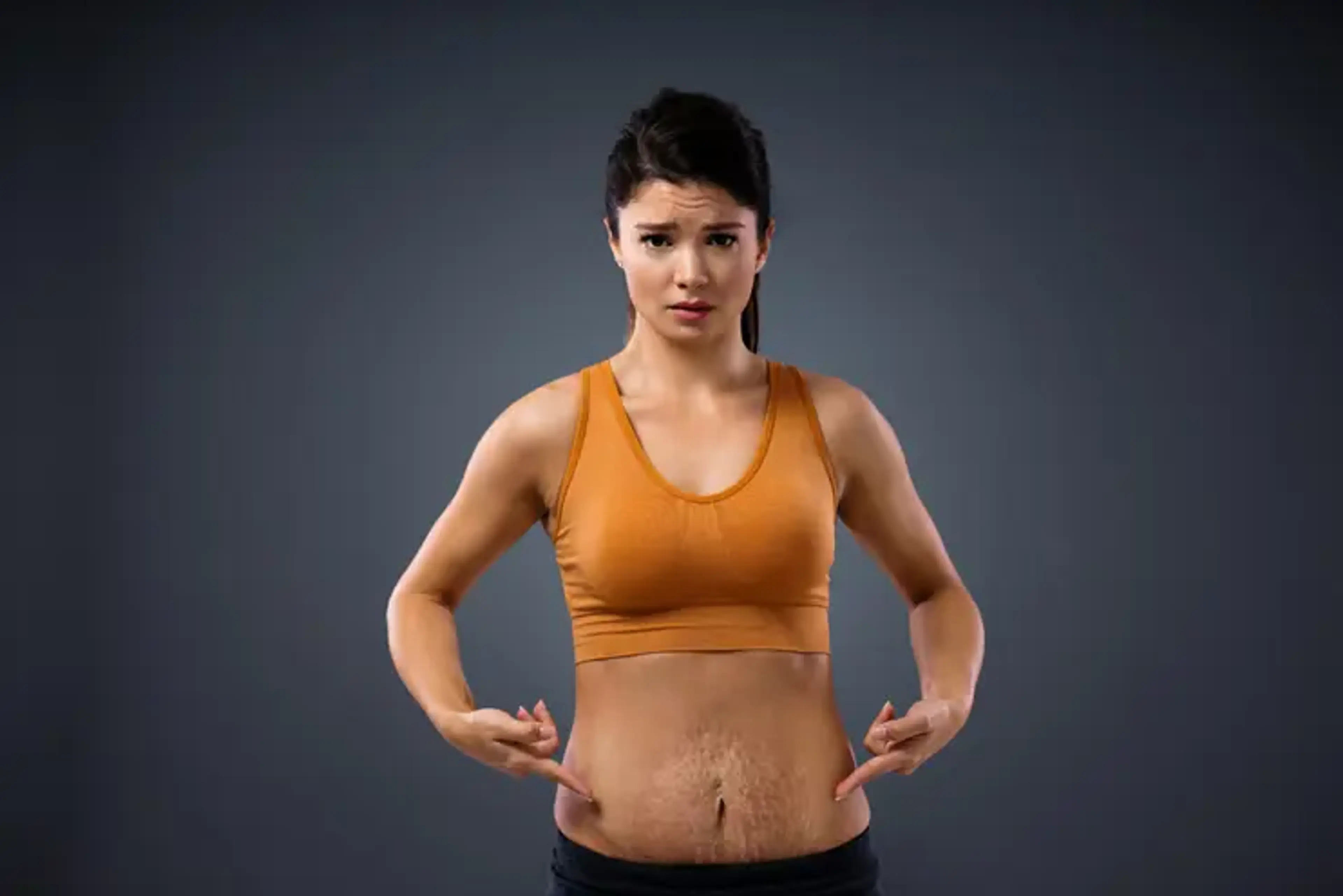 Woman showing pregnancy stretch marks on her abdomen before undergoing stretch mark treatment.