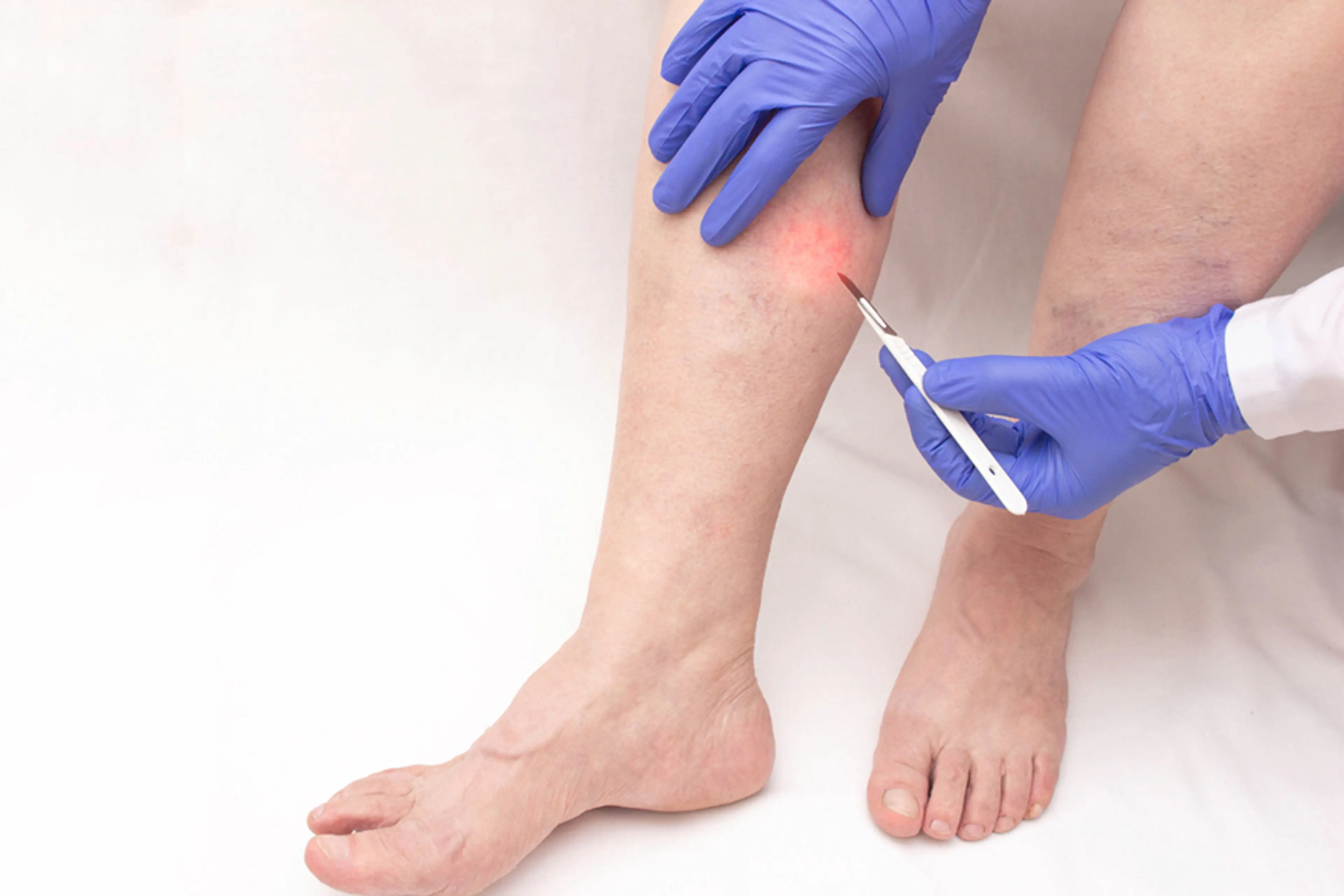 Phlebectomy