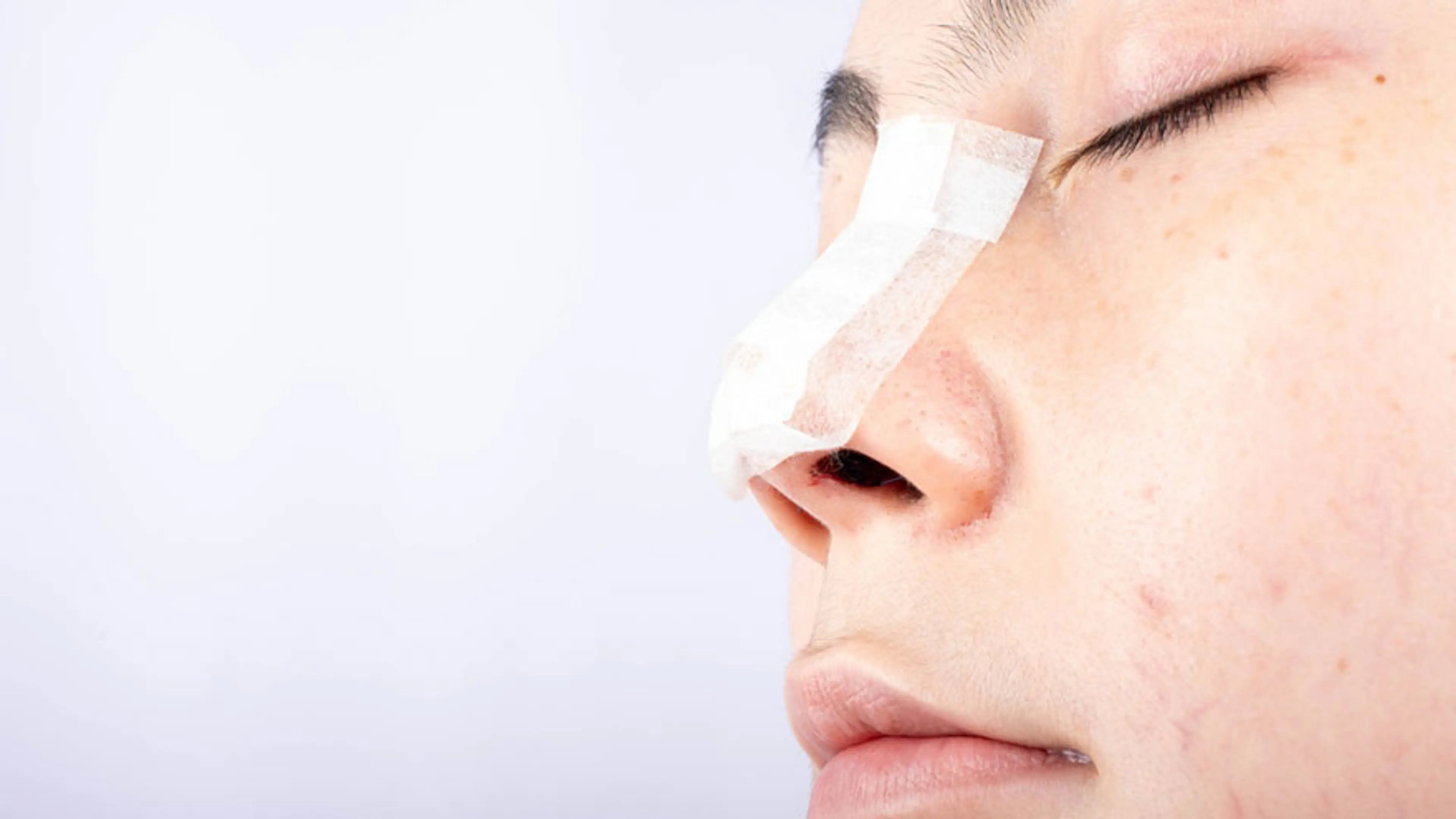 Nose Surgery for a Bulbous Tip