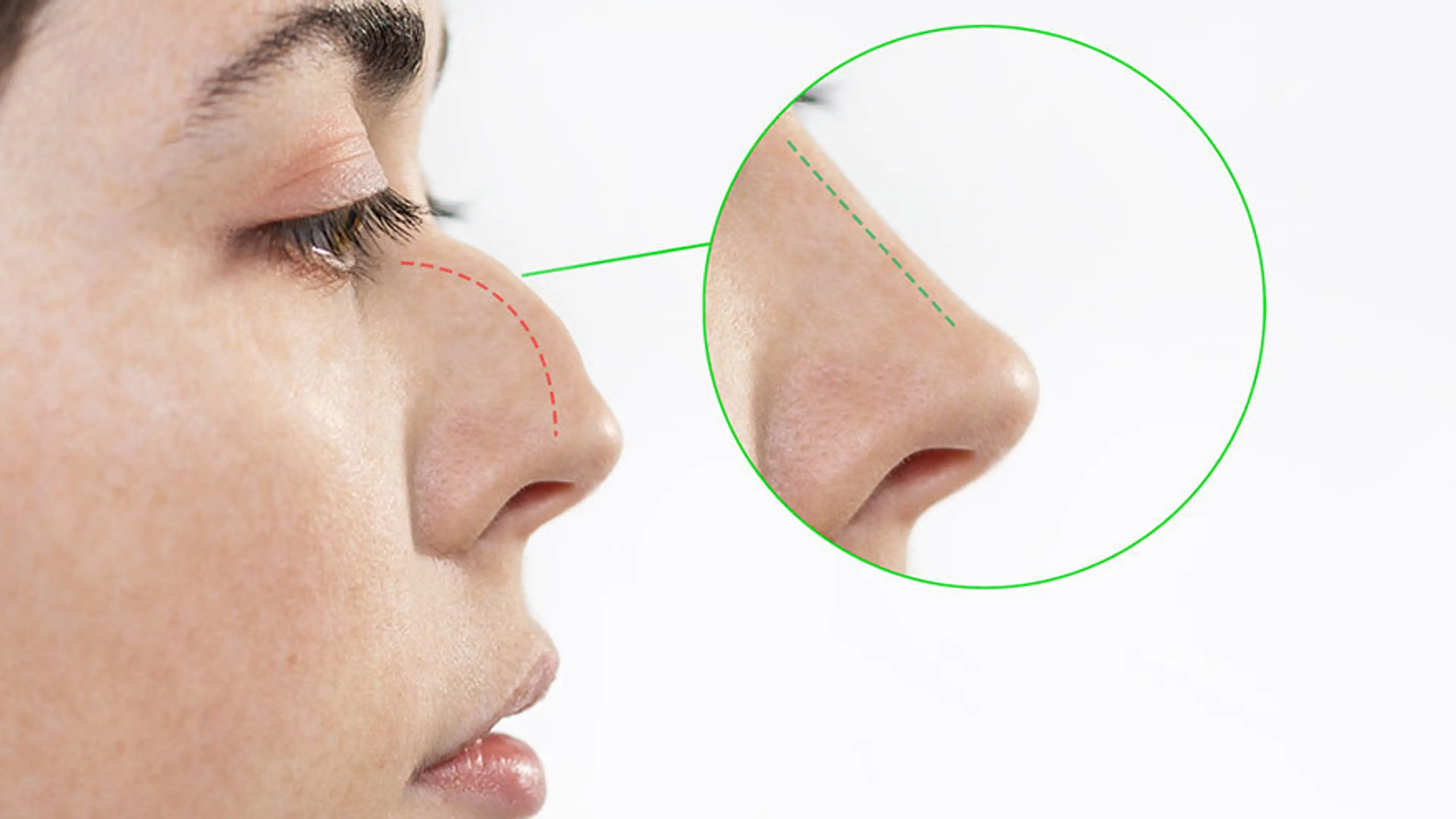 Defined Nose with Rhinoplasty