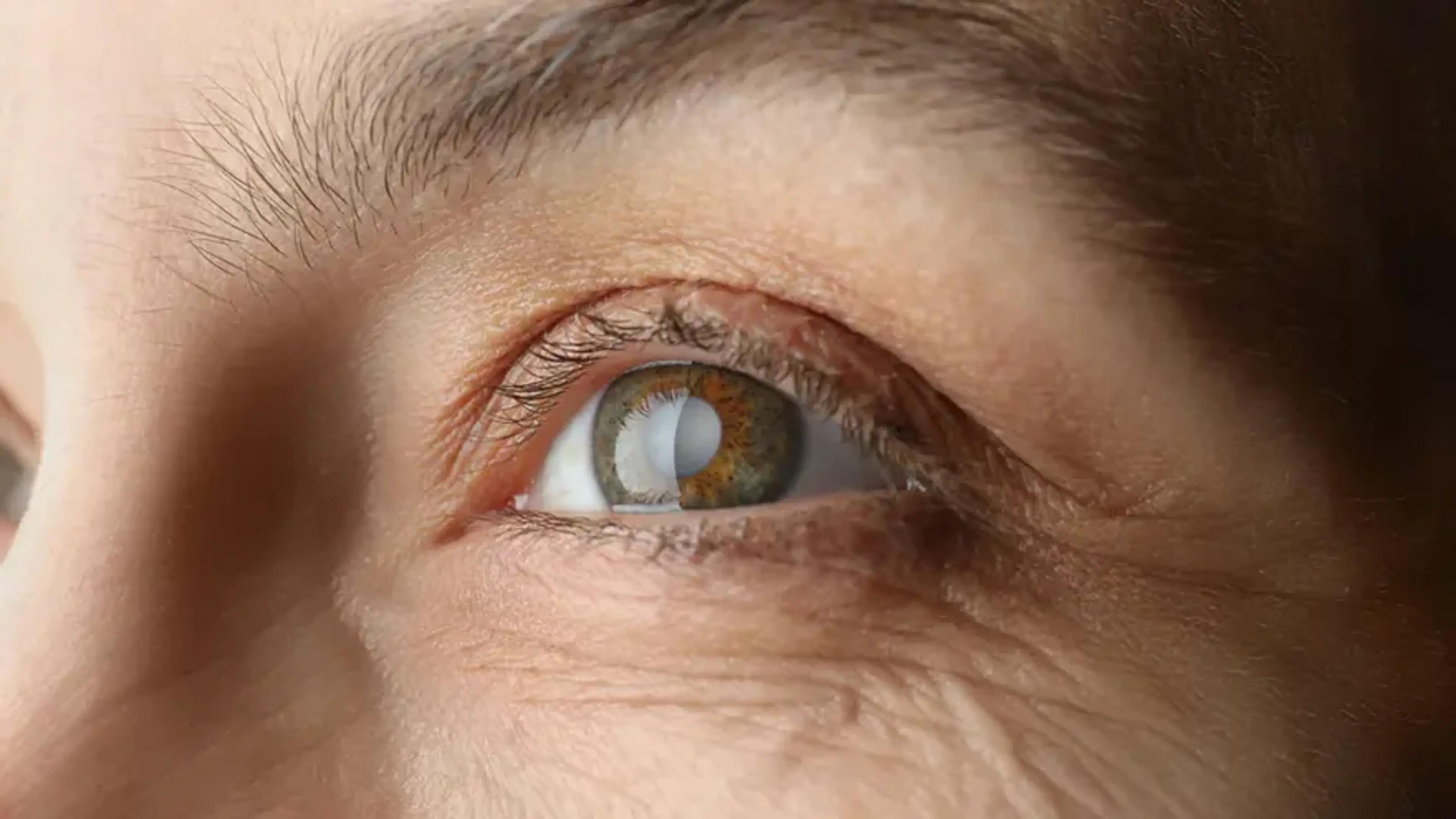 Cataract