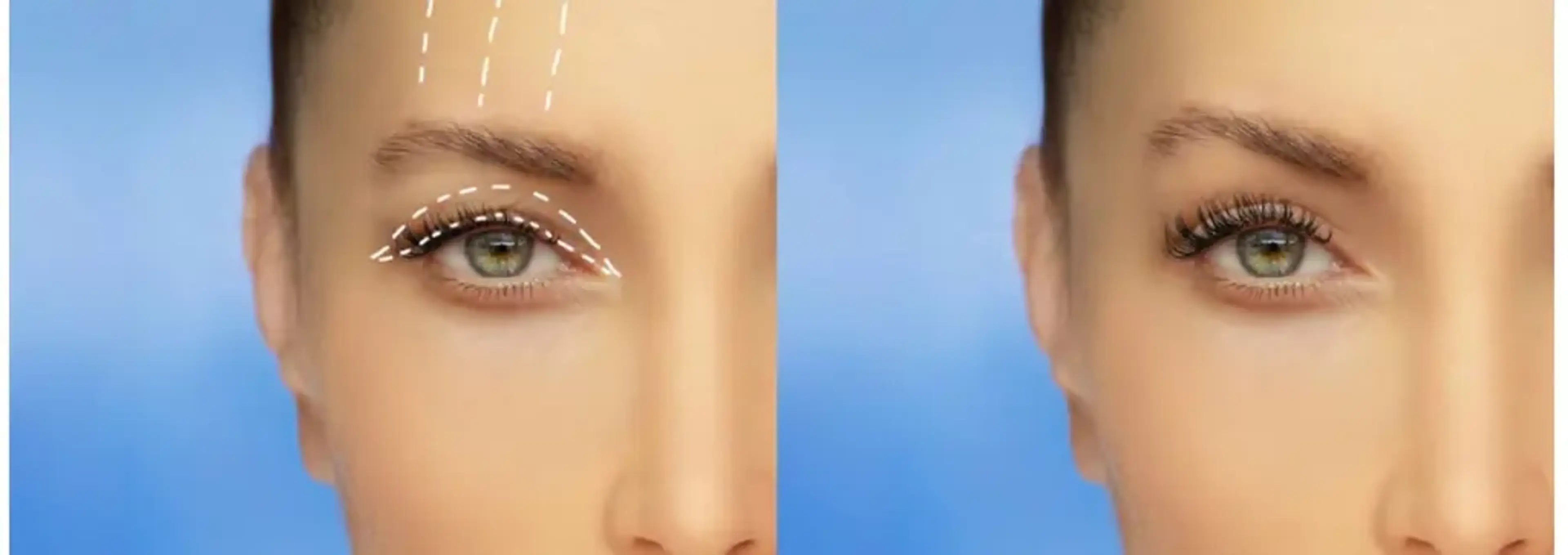 1mm Plastic Surgery