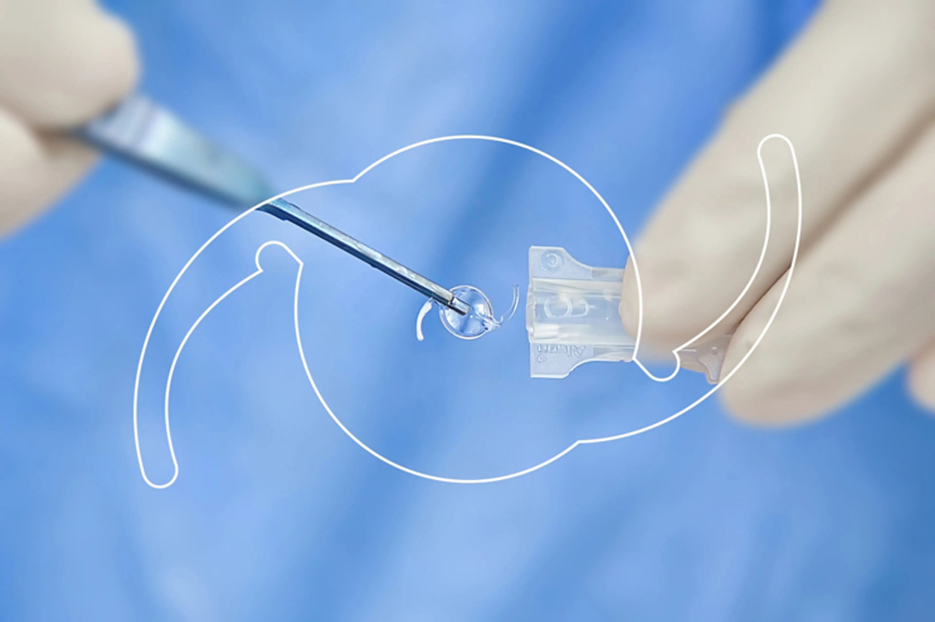 人工晶状体植入