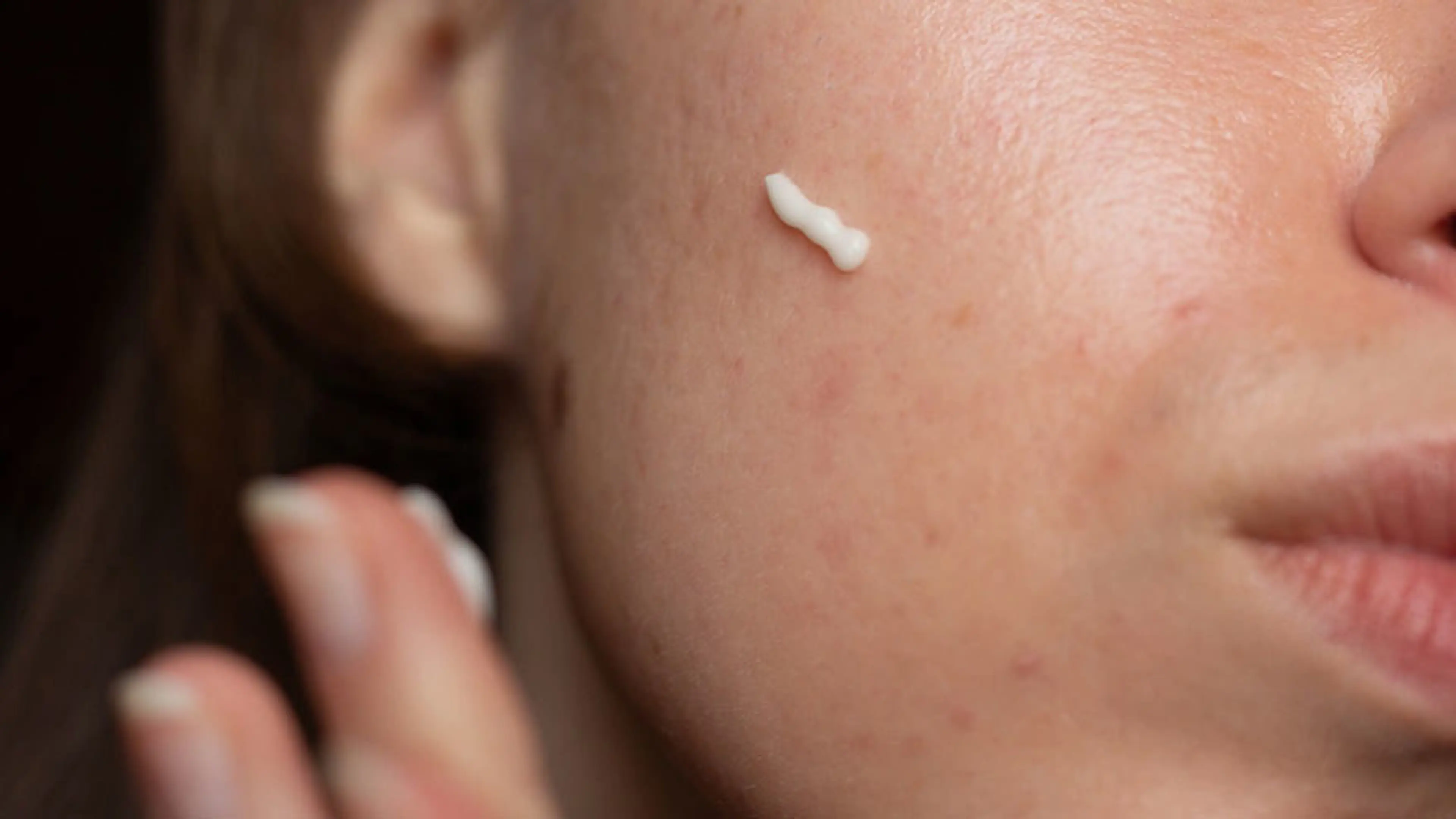 Acne Scarring