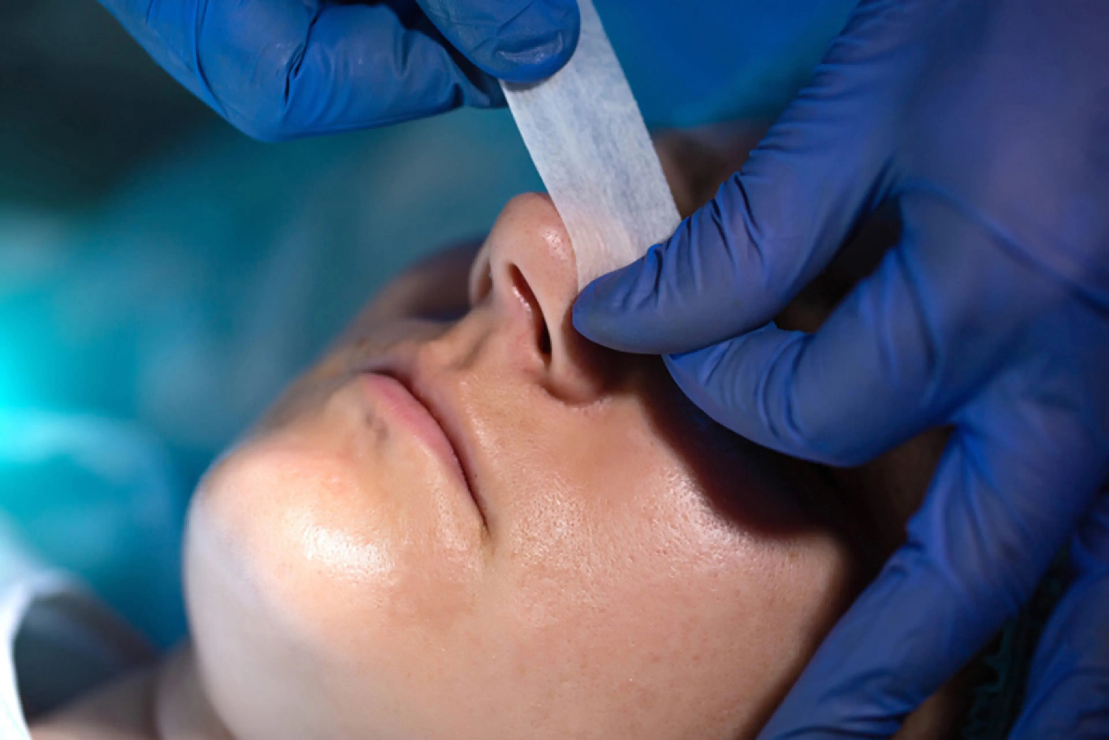 鼻孔不對稱的鼻整形手術