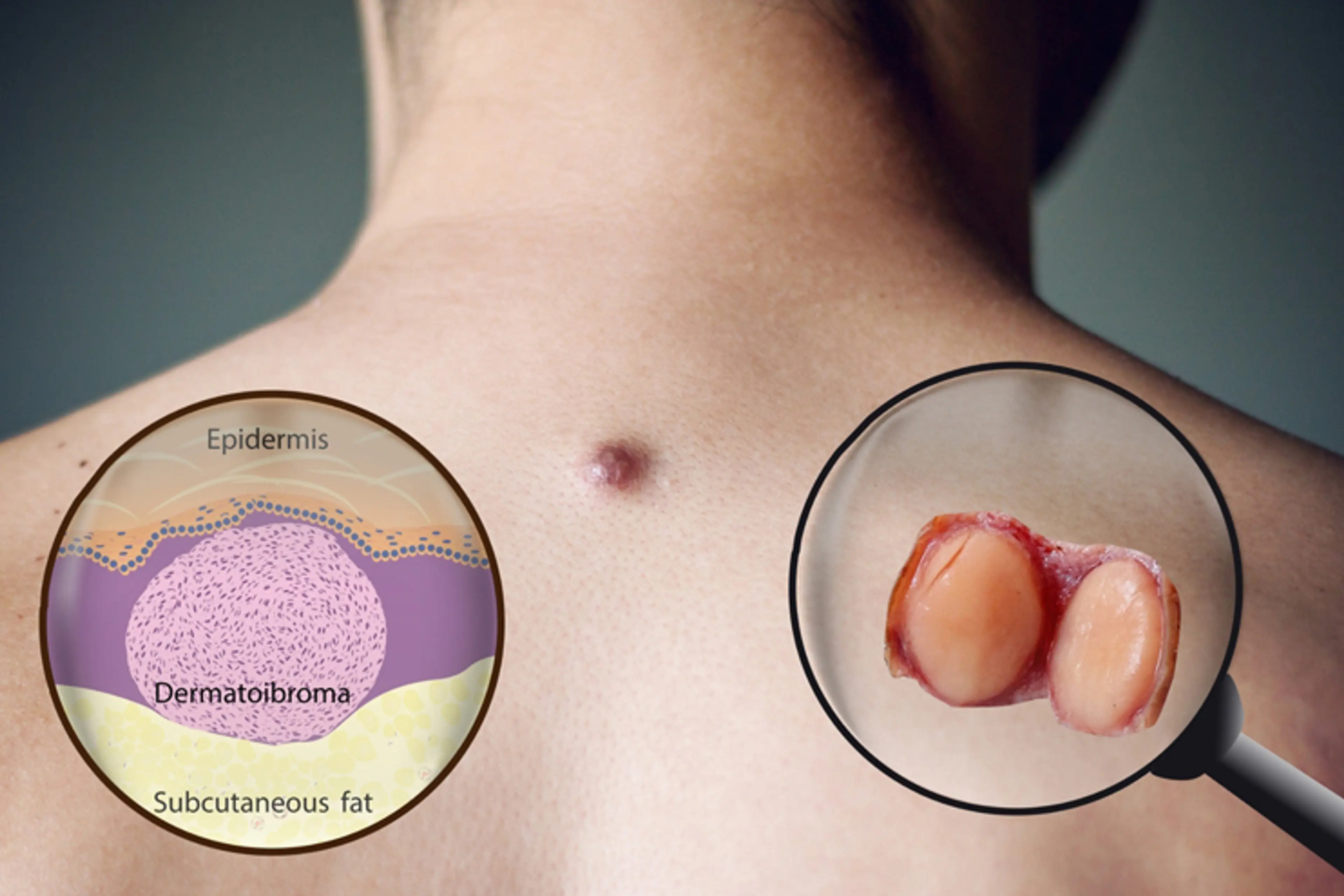 Fibroma