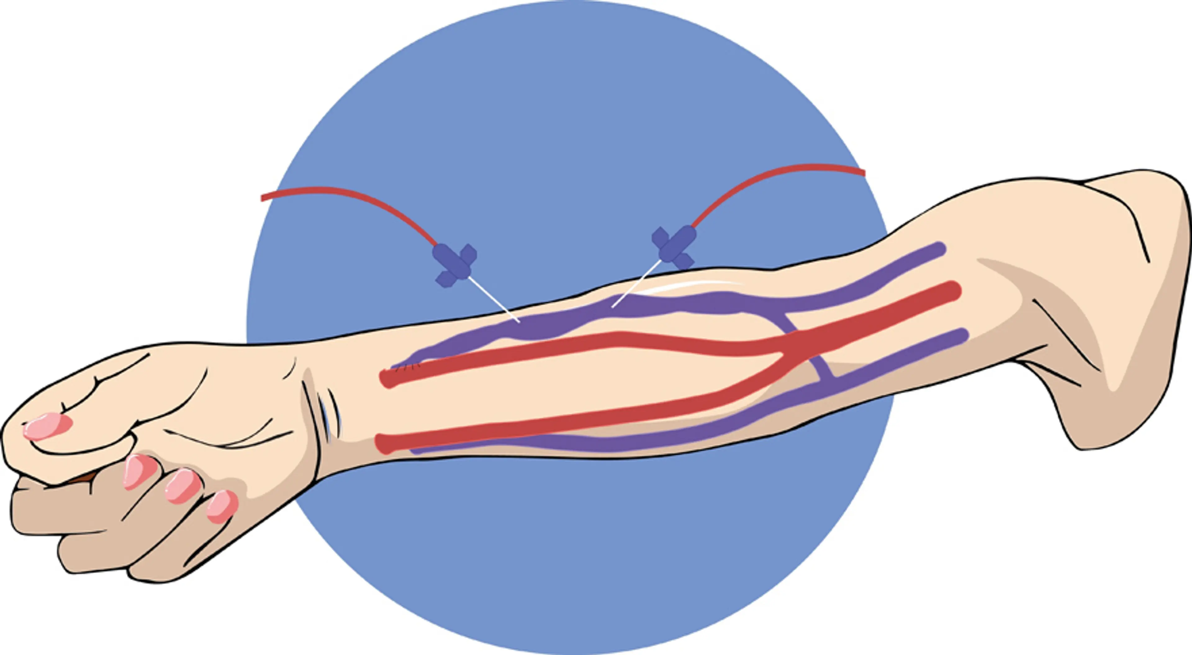 AV fistula