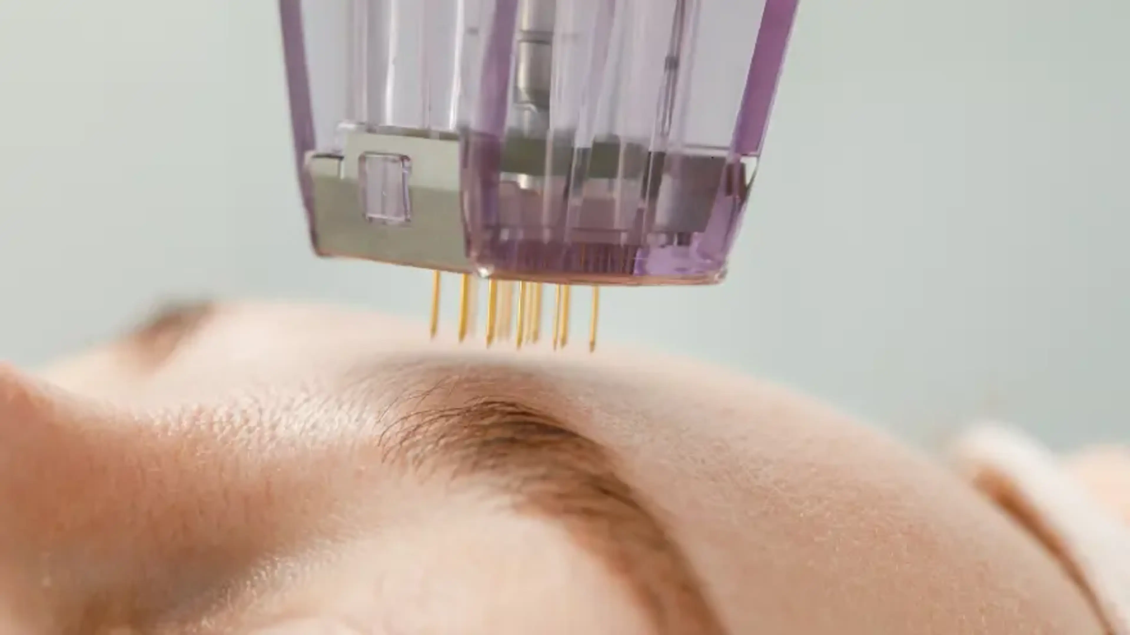 Microneedling Treatments