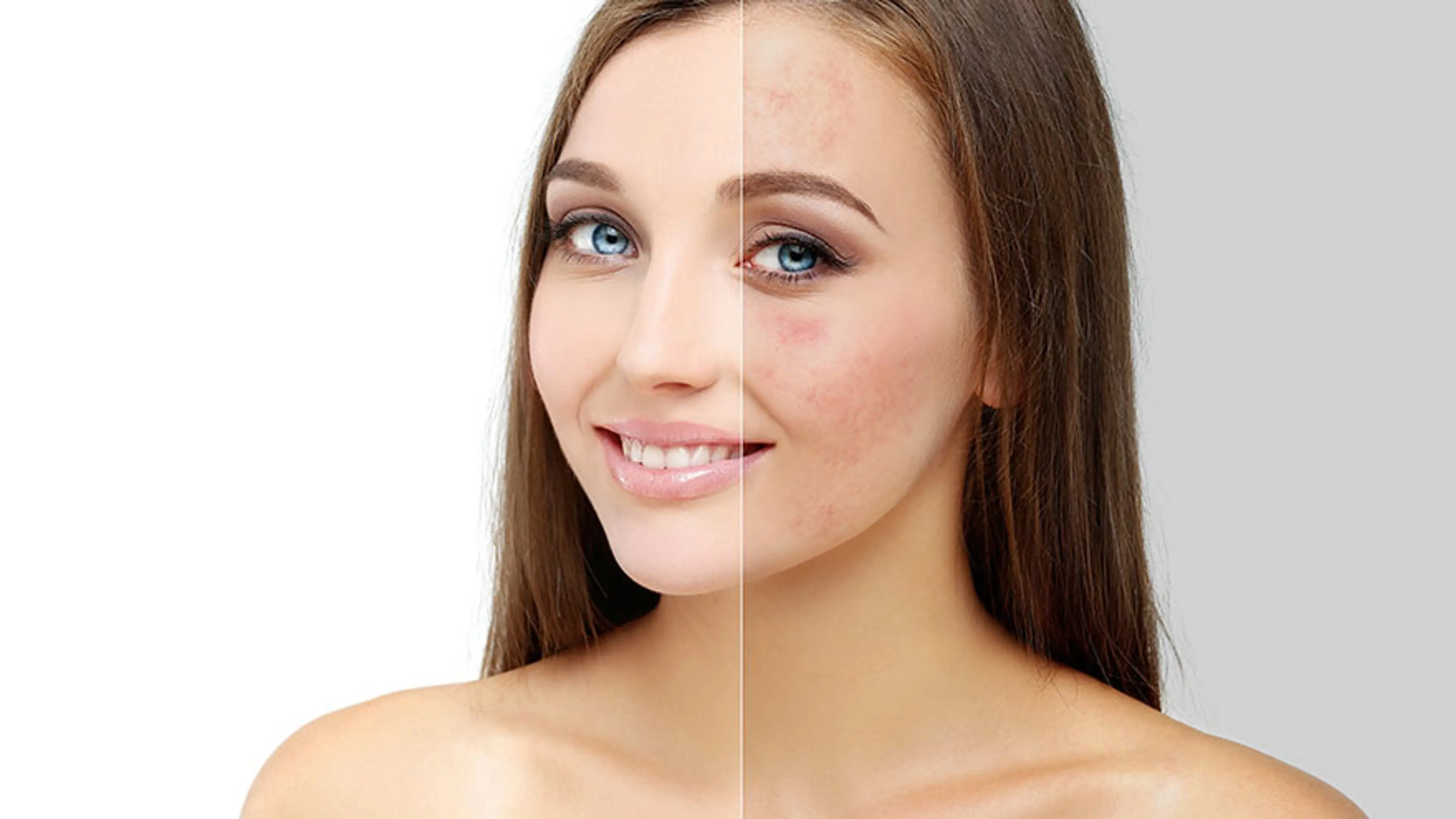 ピーリング後の赤み