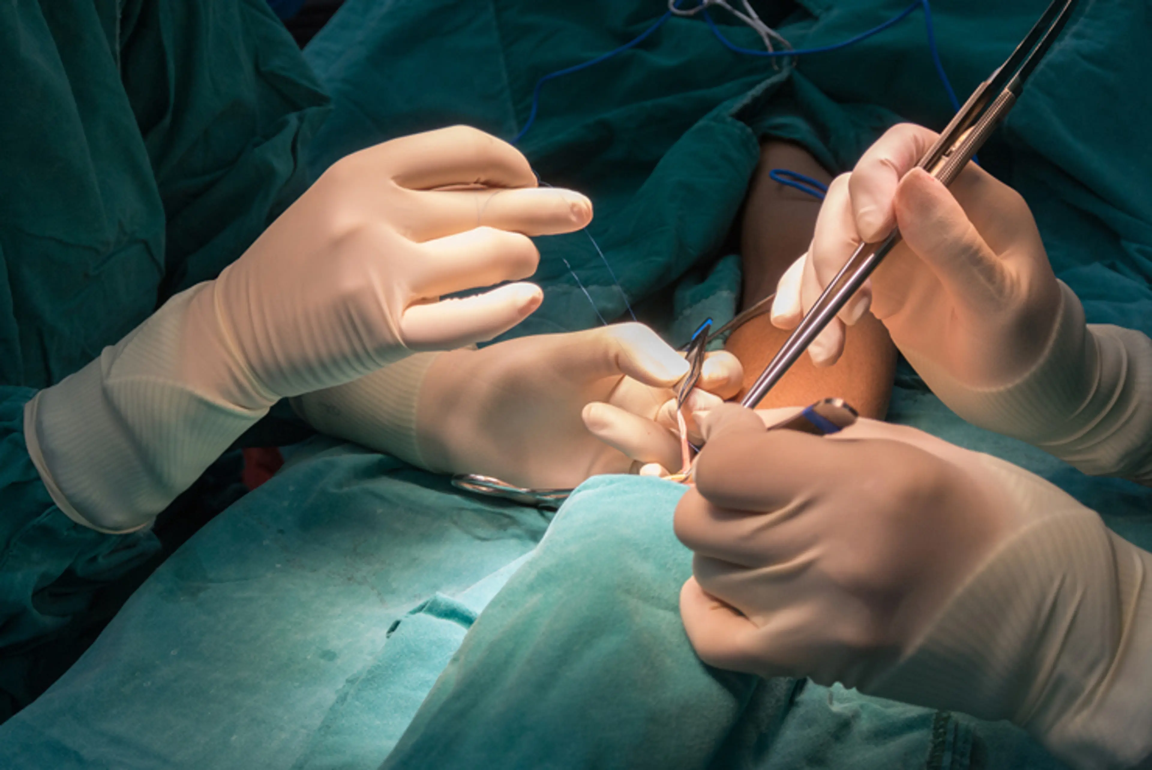 Arteriovenous Fistula