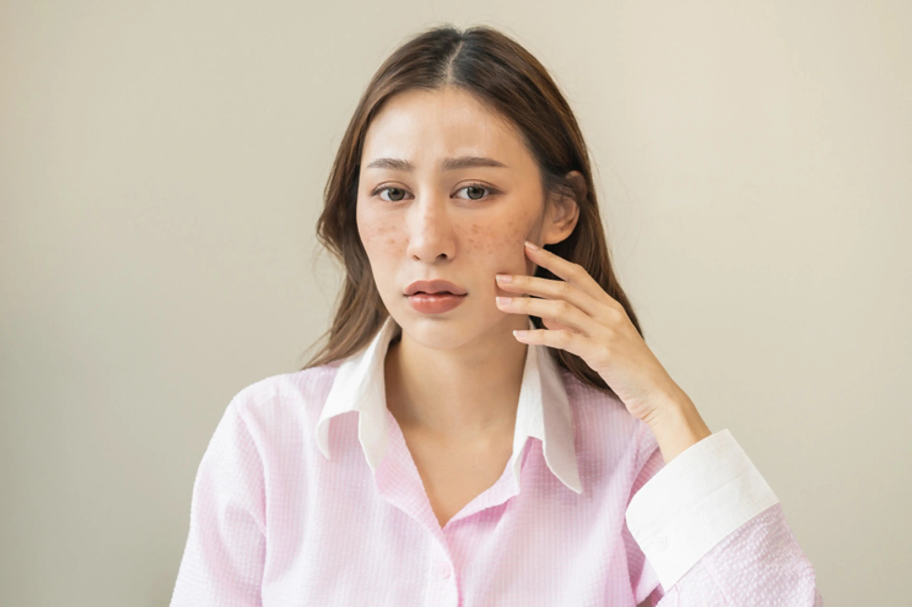 黄褐斑治疗