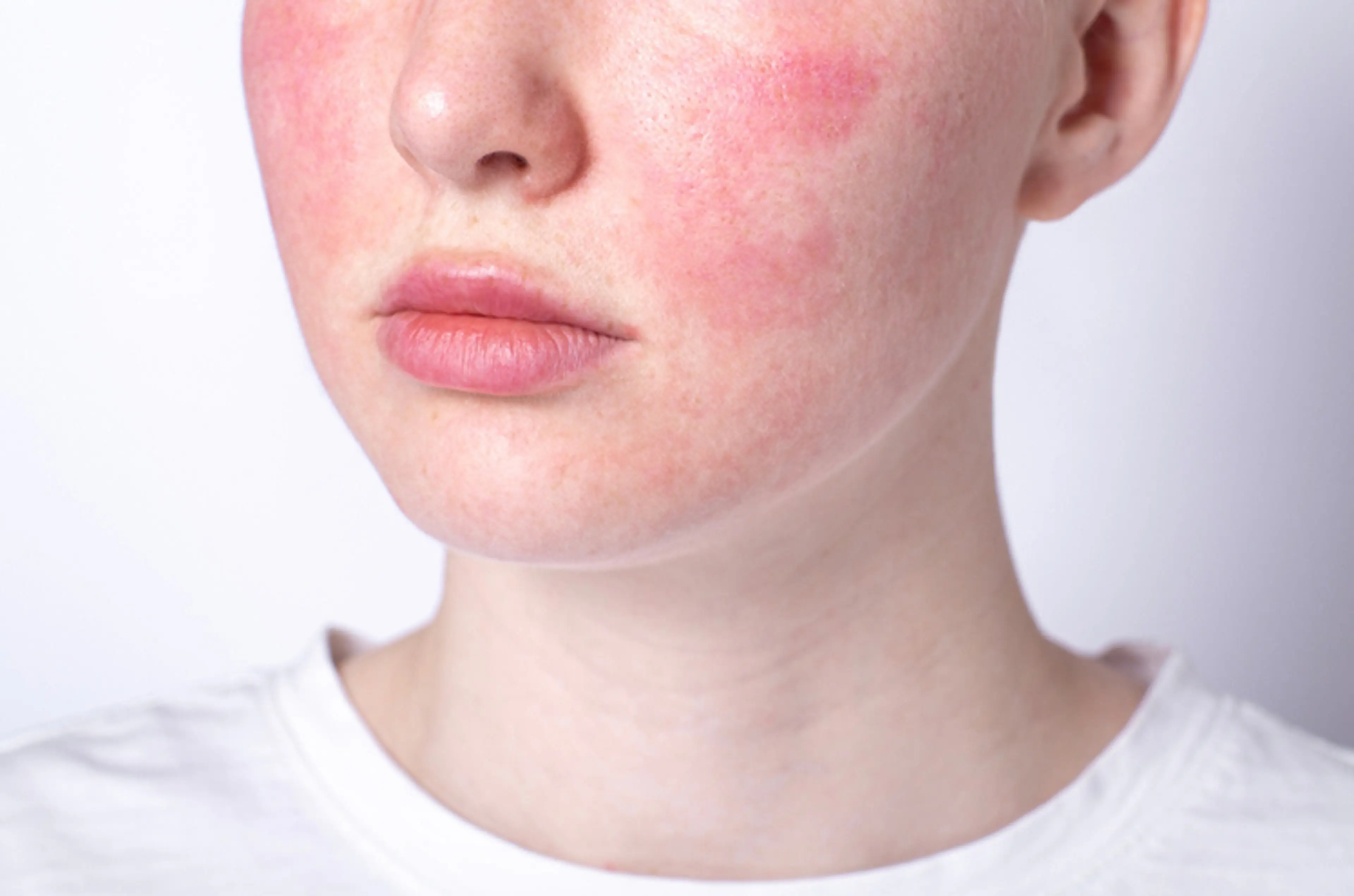 rosacea, dermatitis