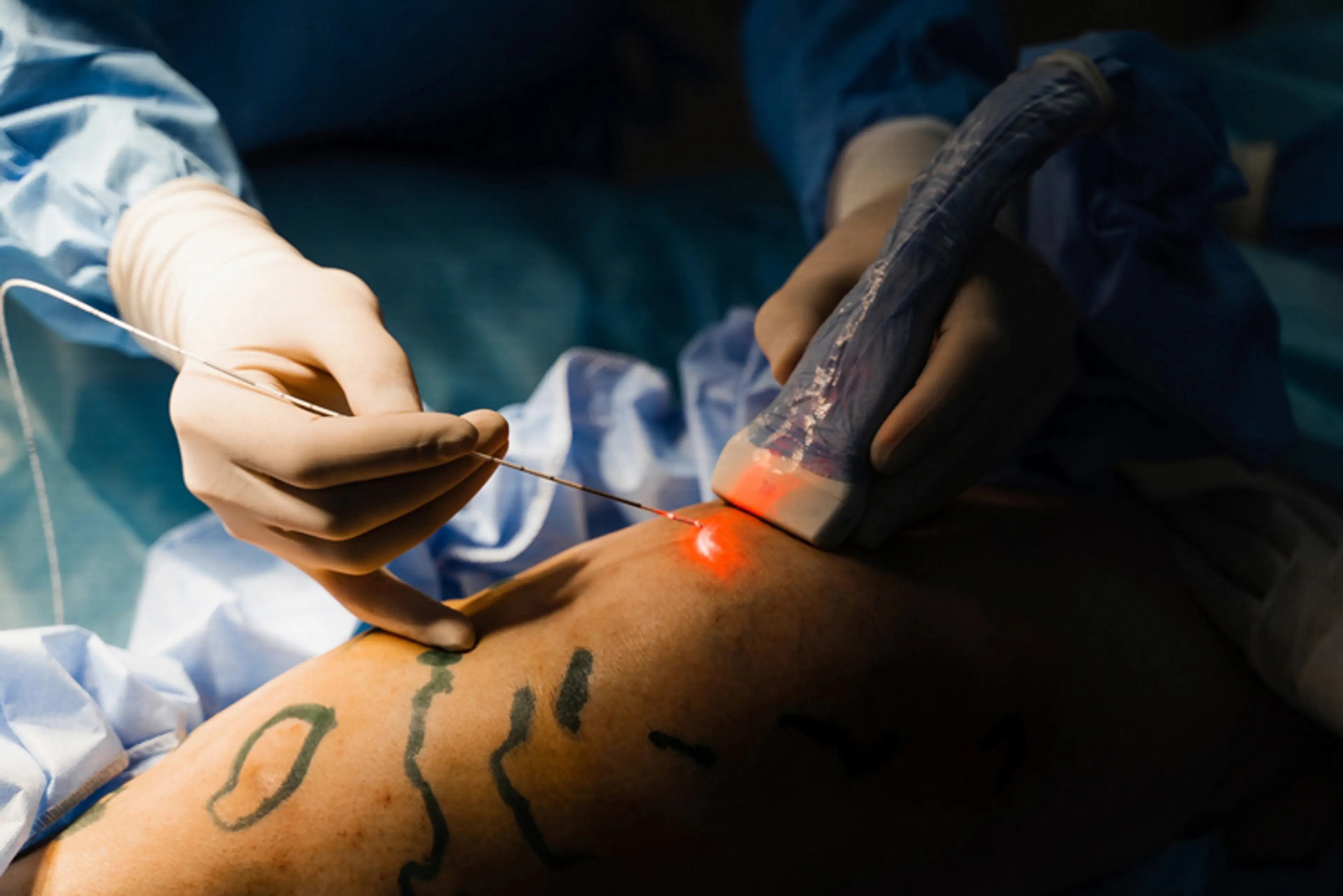 Endovenous Laser Ablation
