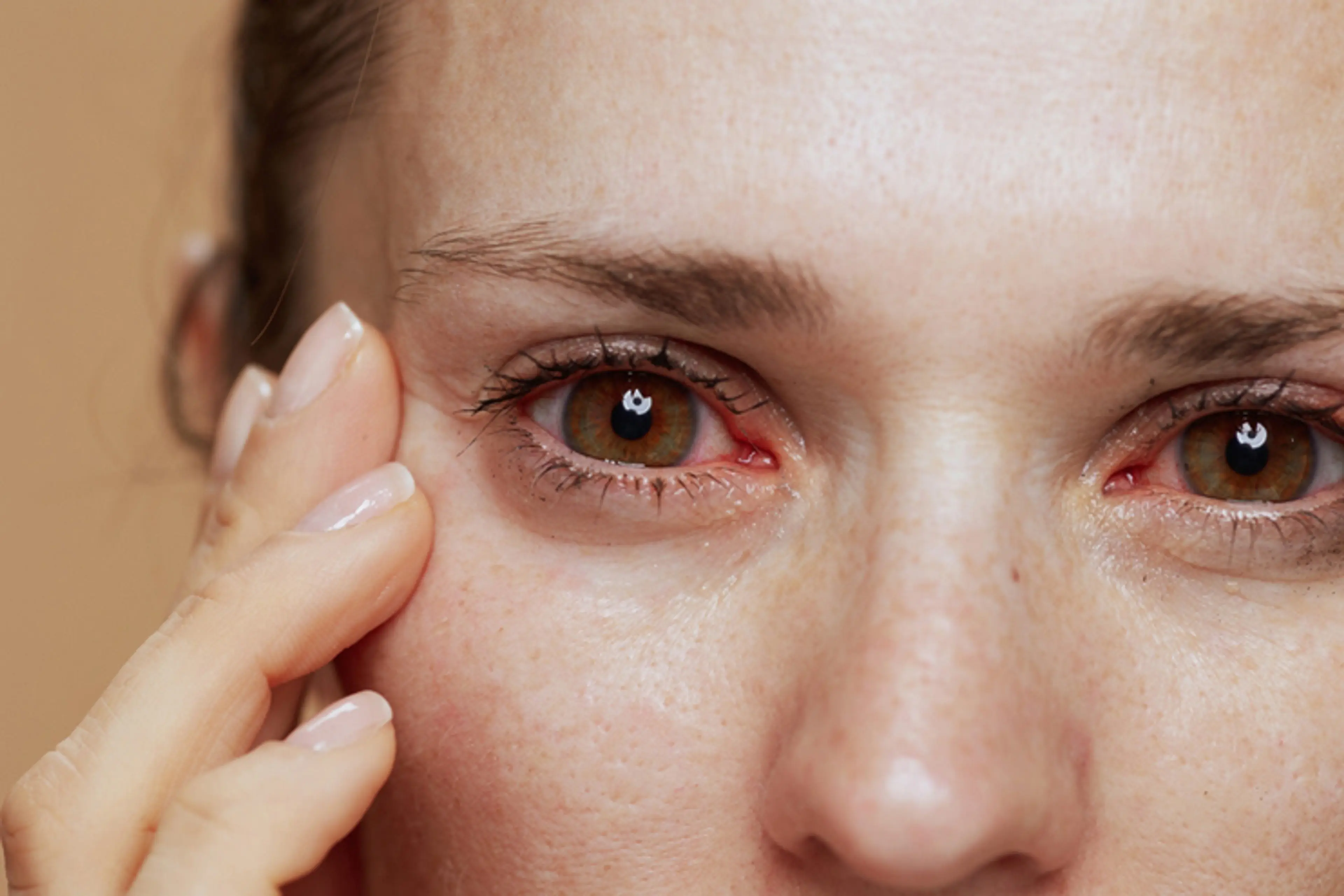 Red Eyes After LASIK
