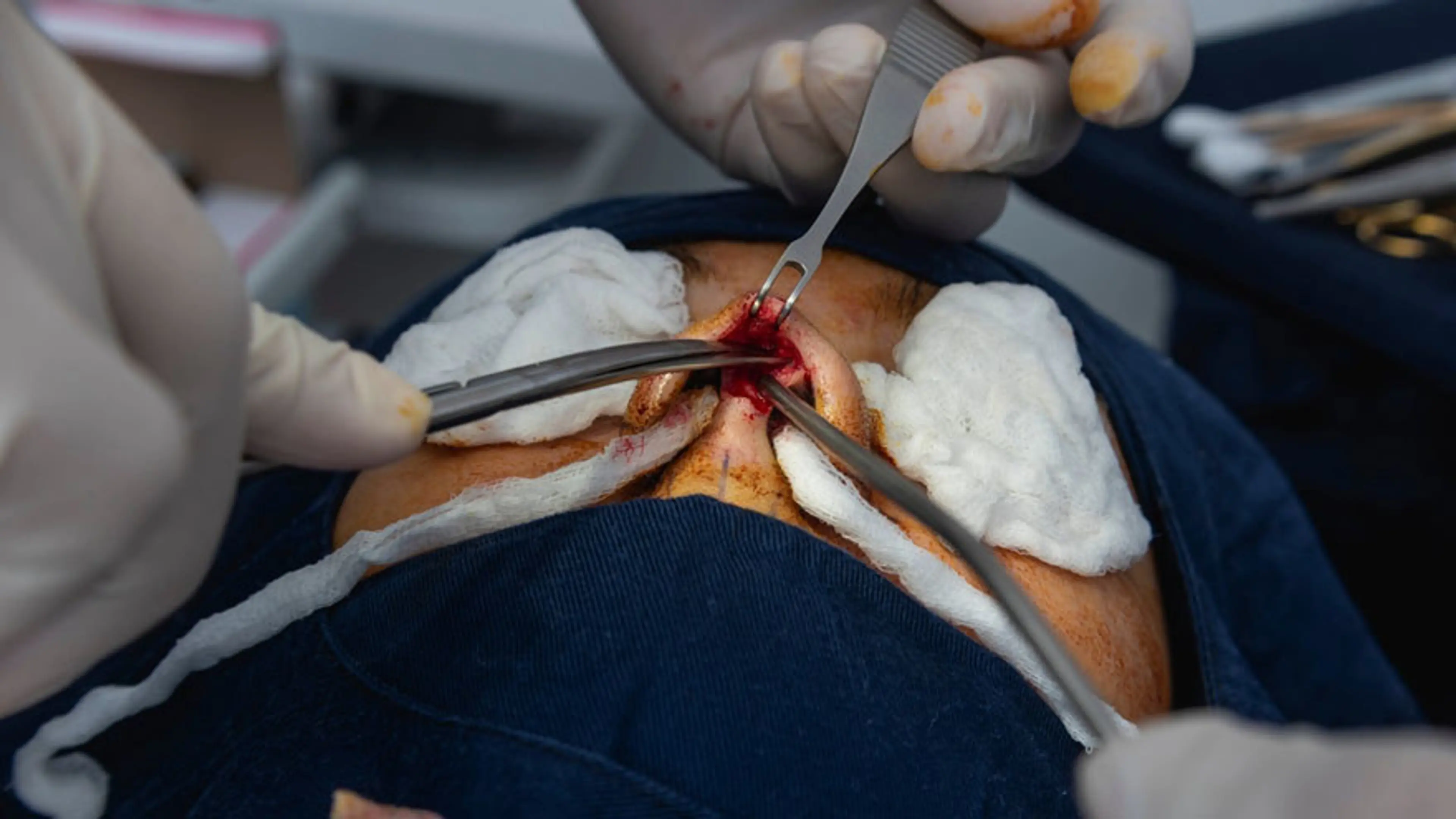 Nose Bridge Surgery