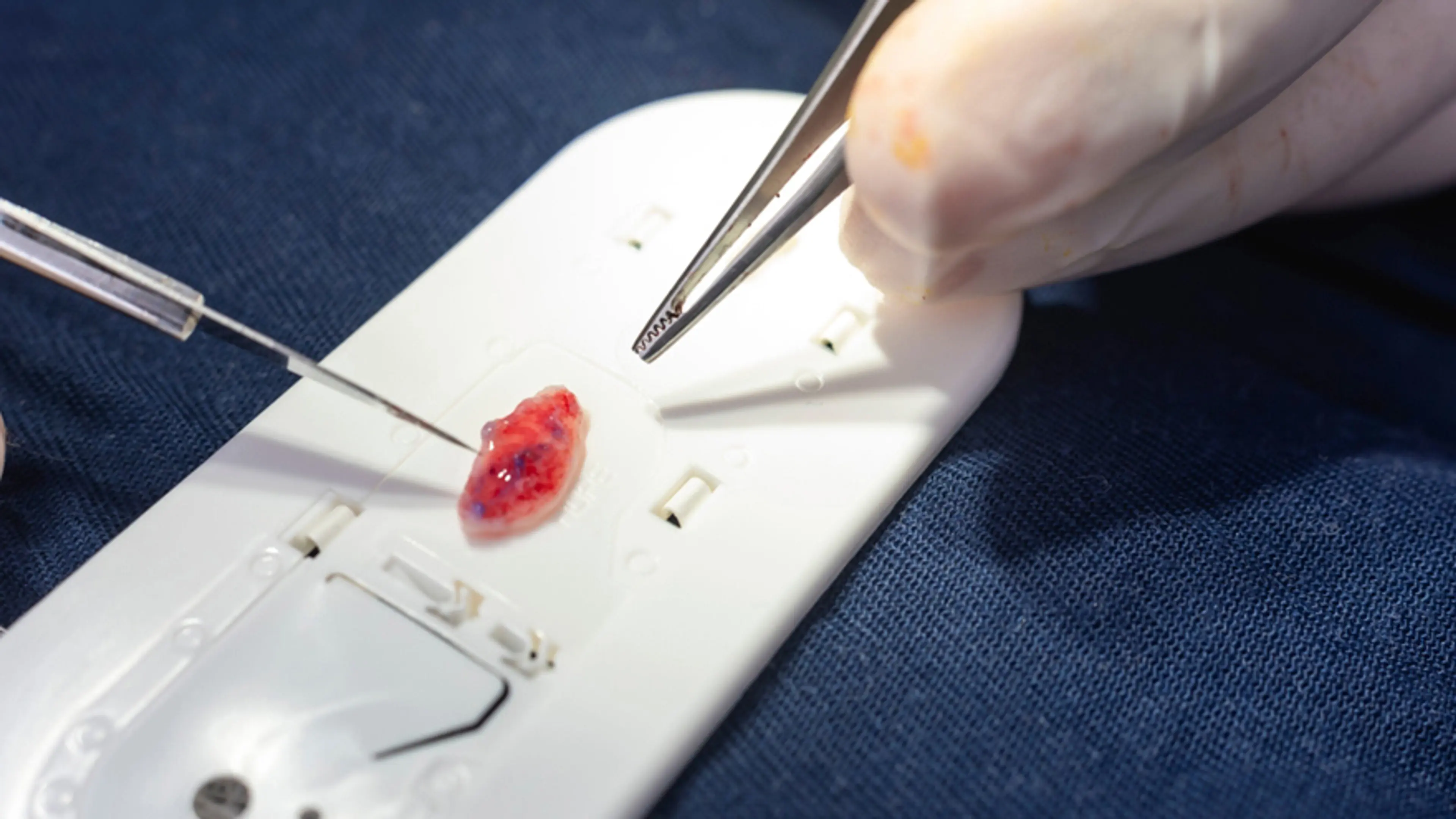 Cartilage Grafting Rhinoplasty