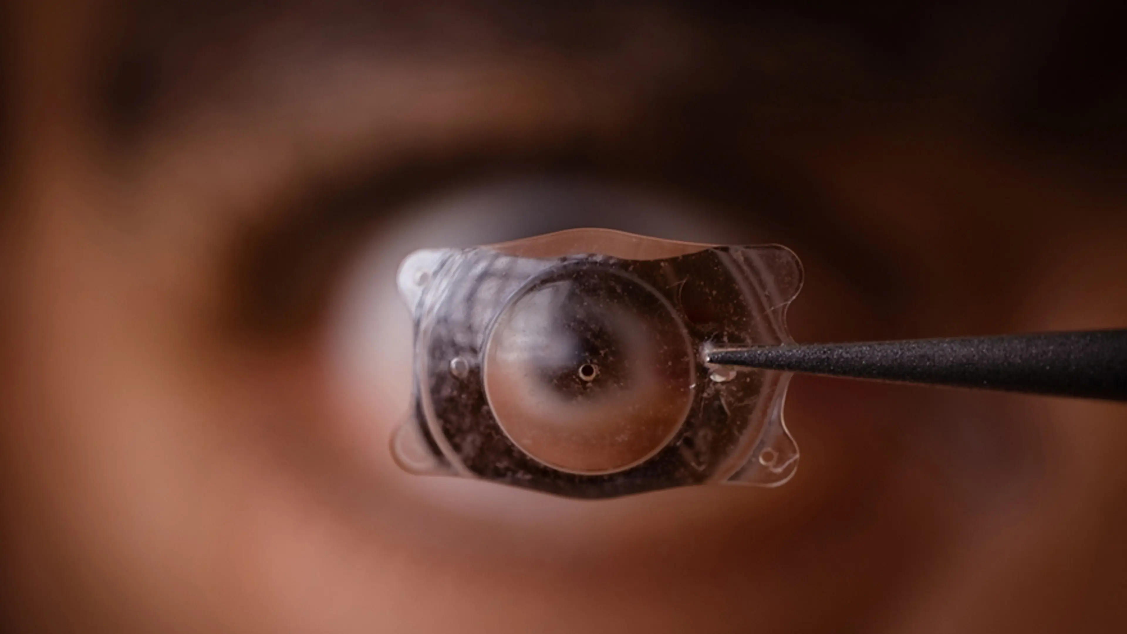 人工晶体植入术