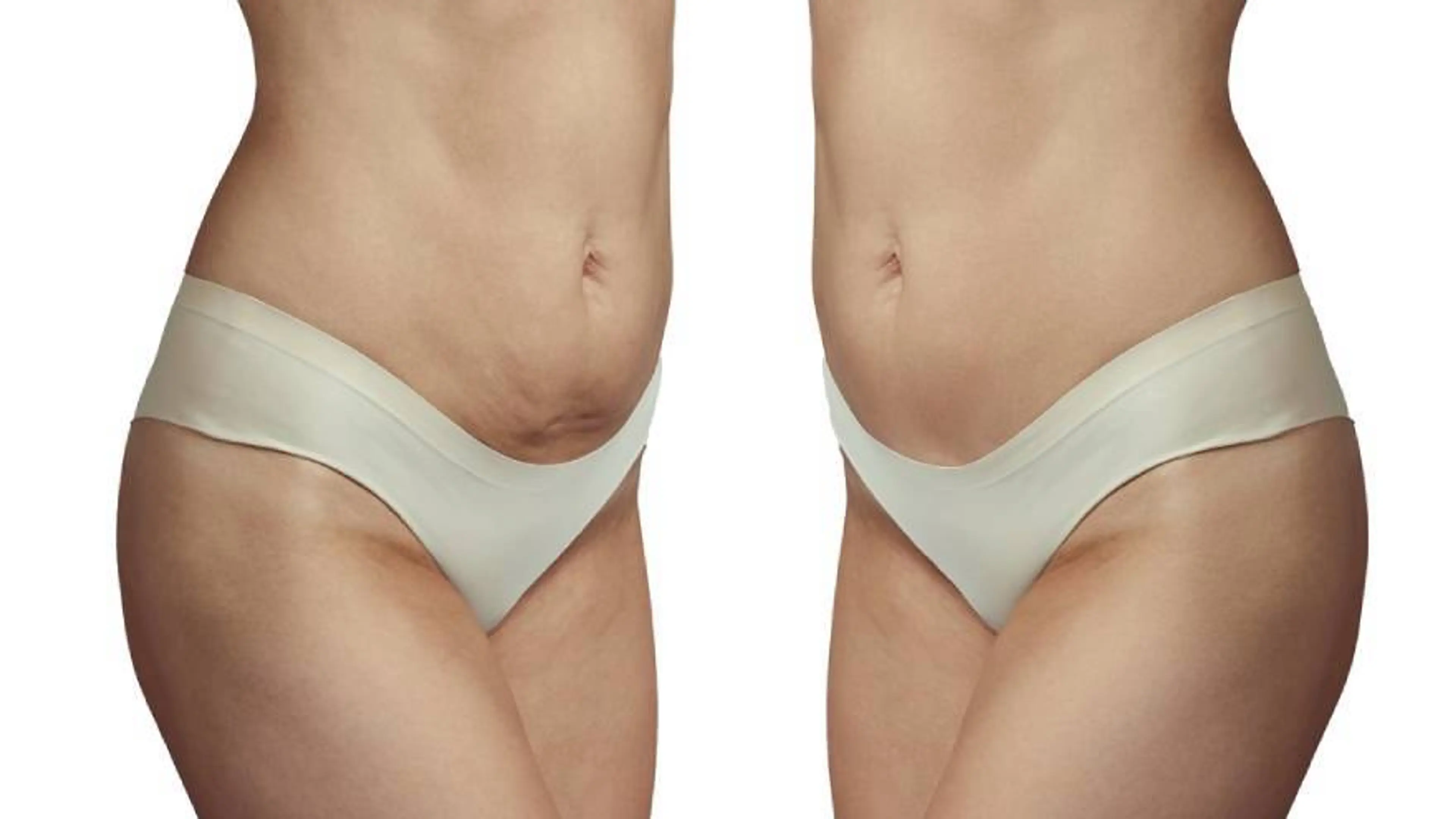 Belly Pouch After Baby