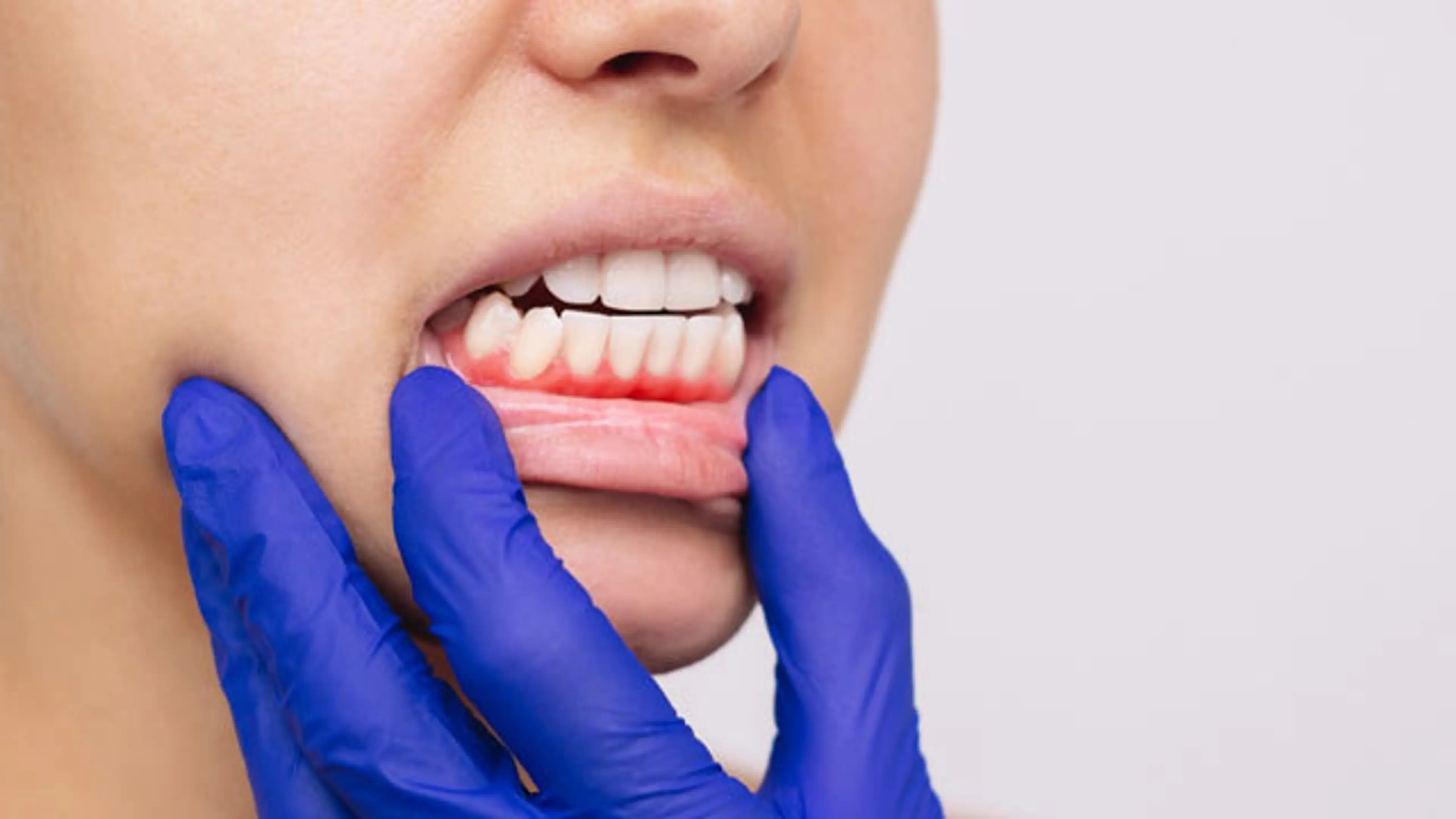 Periodontal Gum Treatment