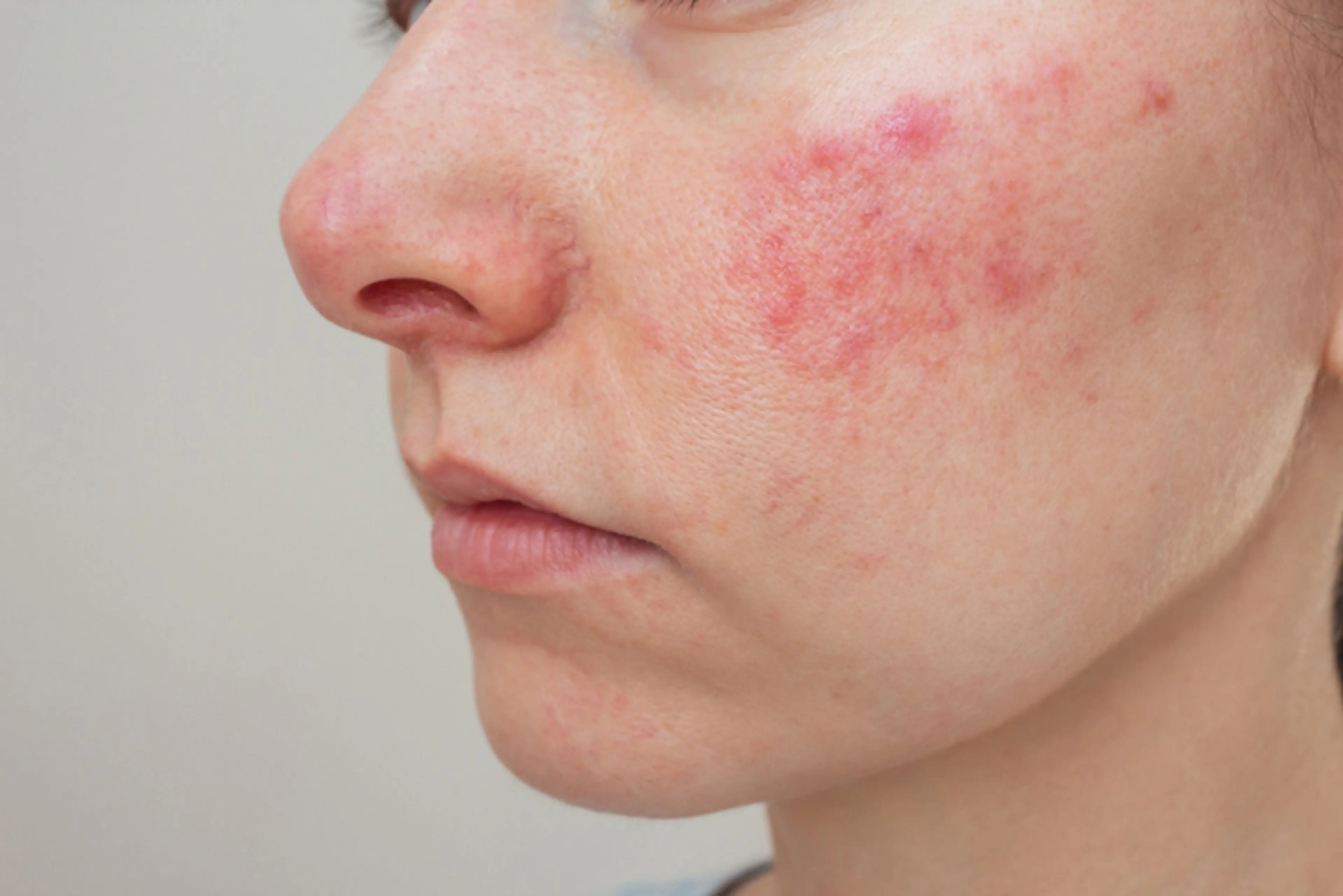 Persistent Acne