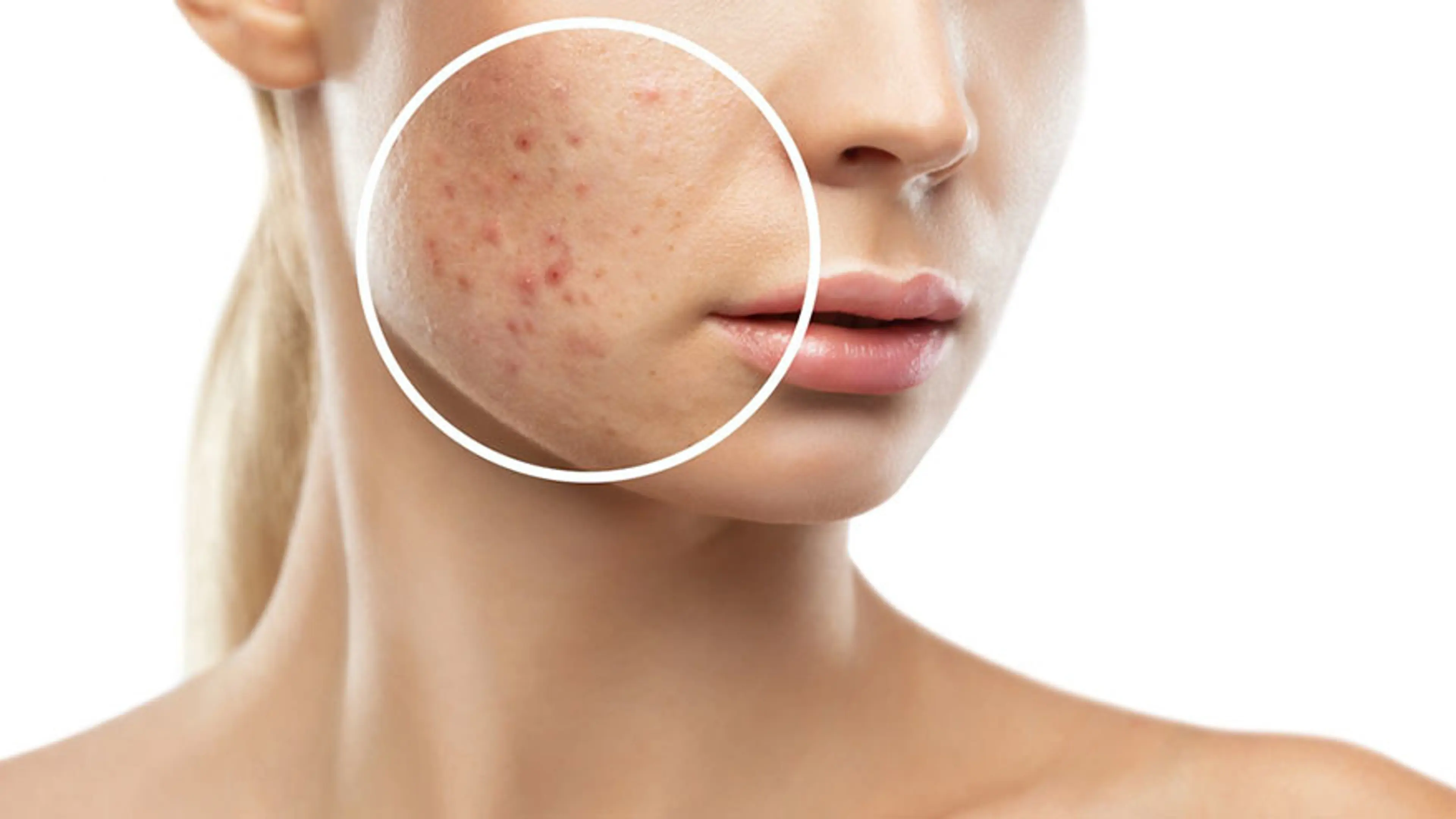Pigmentation Types