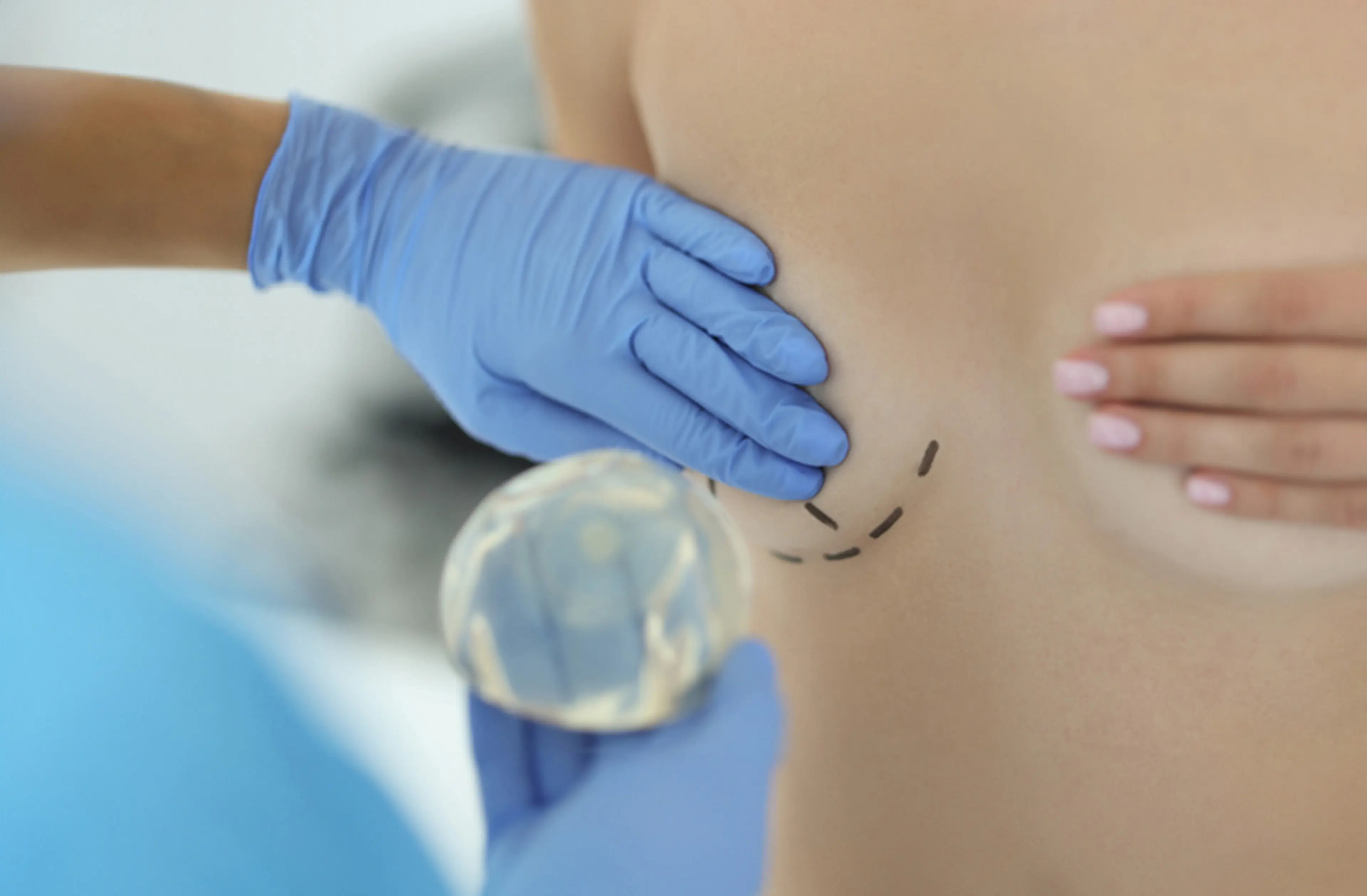 乳房植入物移除重建