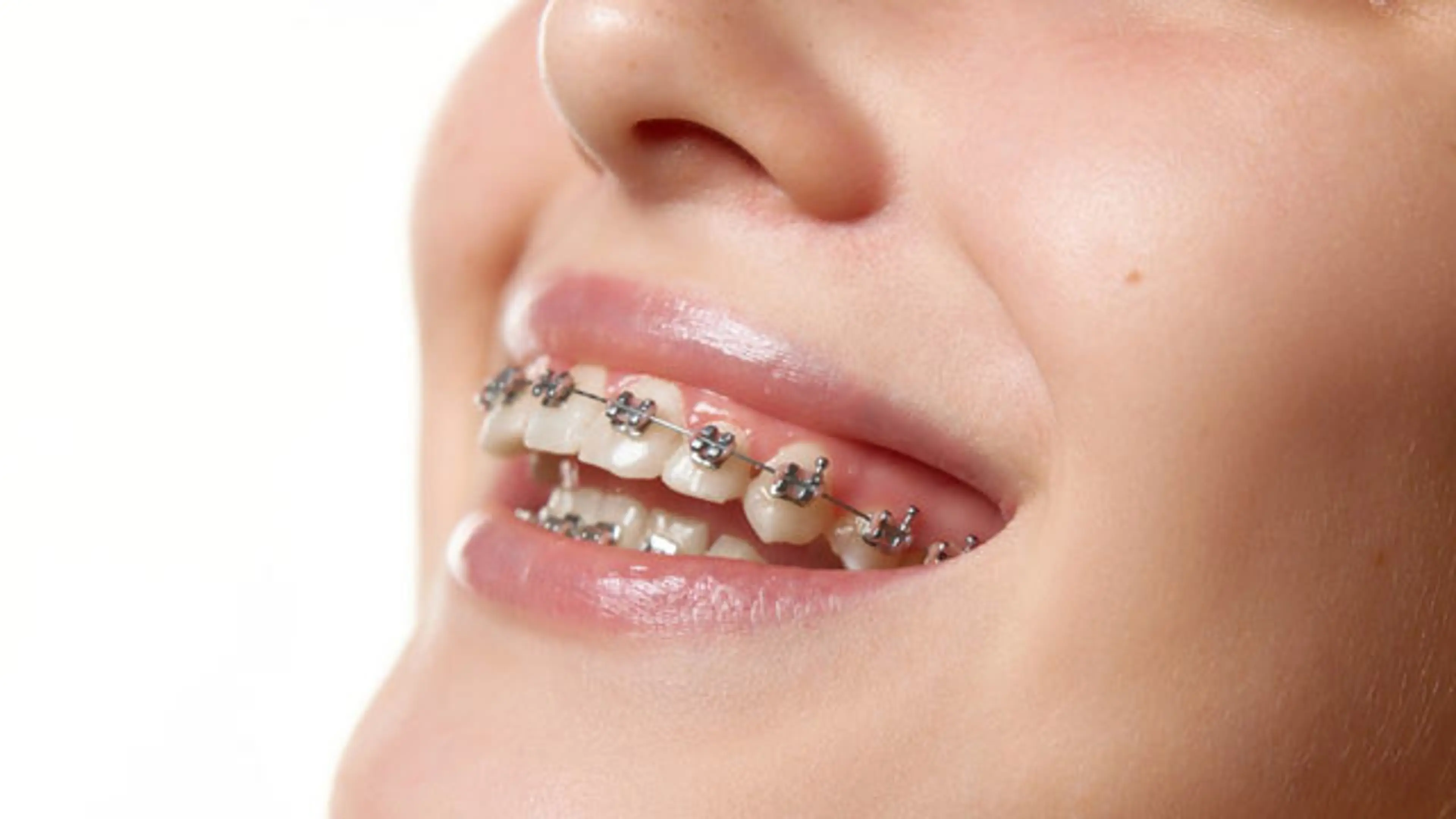 Orthodontic Treatment