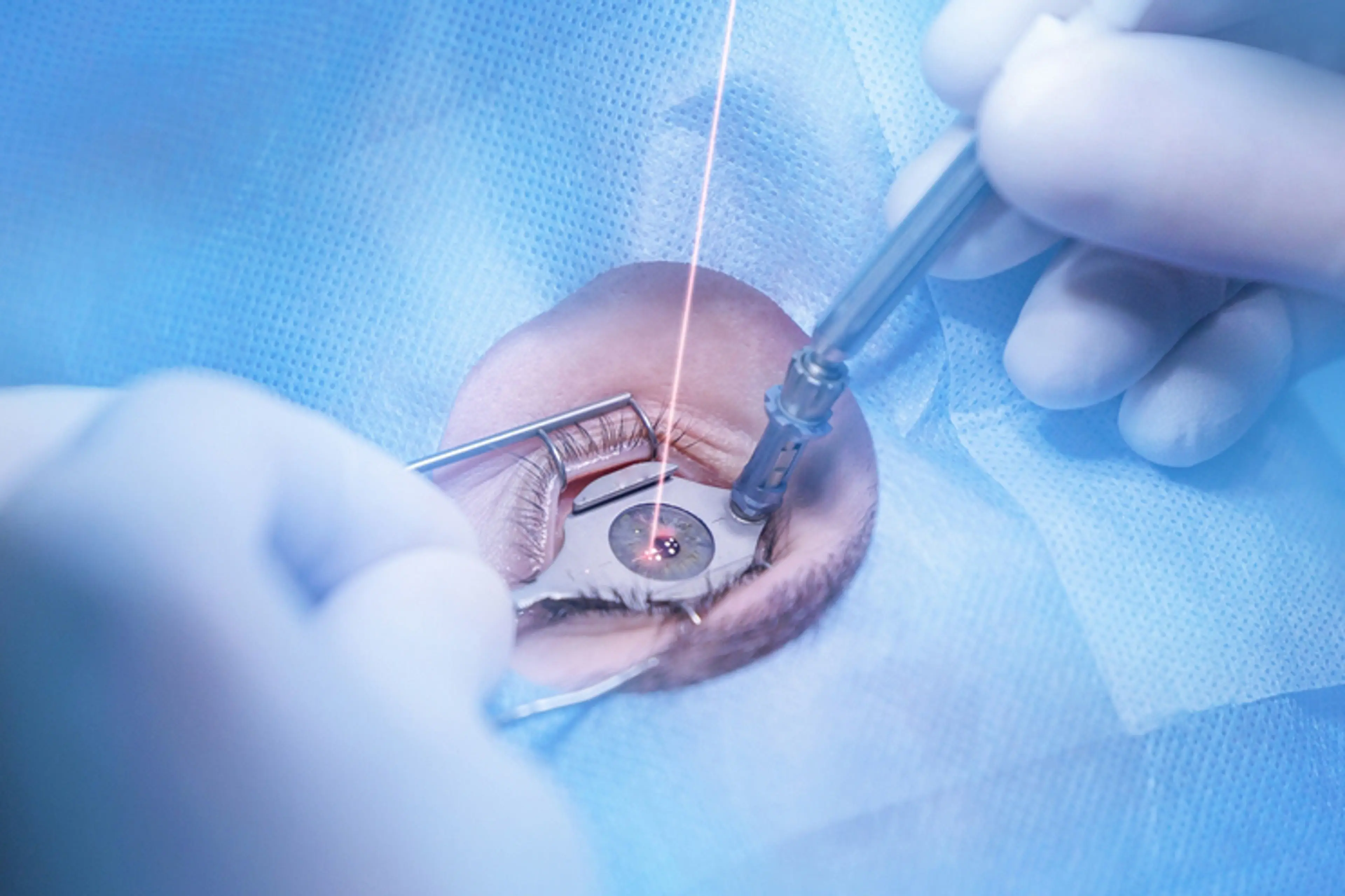 Laser vision correction procedure in progress, showing precise laser treatment on the eye during advanced refractive surgery to improve eyesight.  Select 73 more words to run Humanizer.