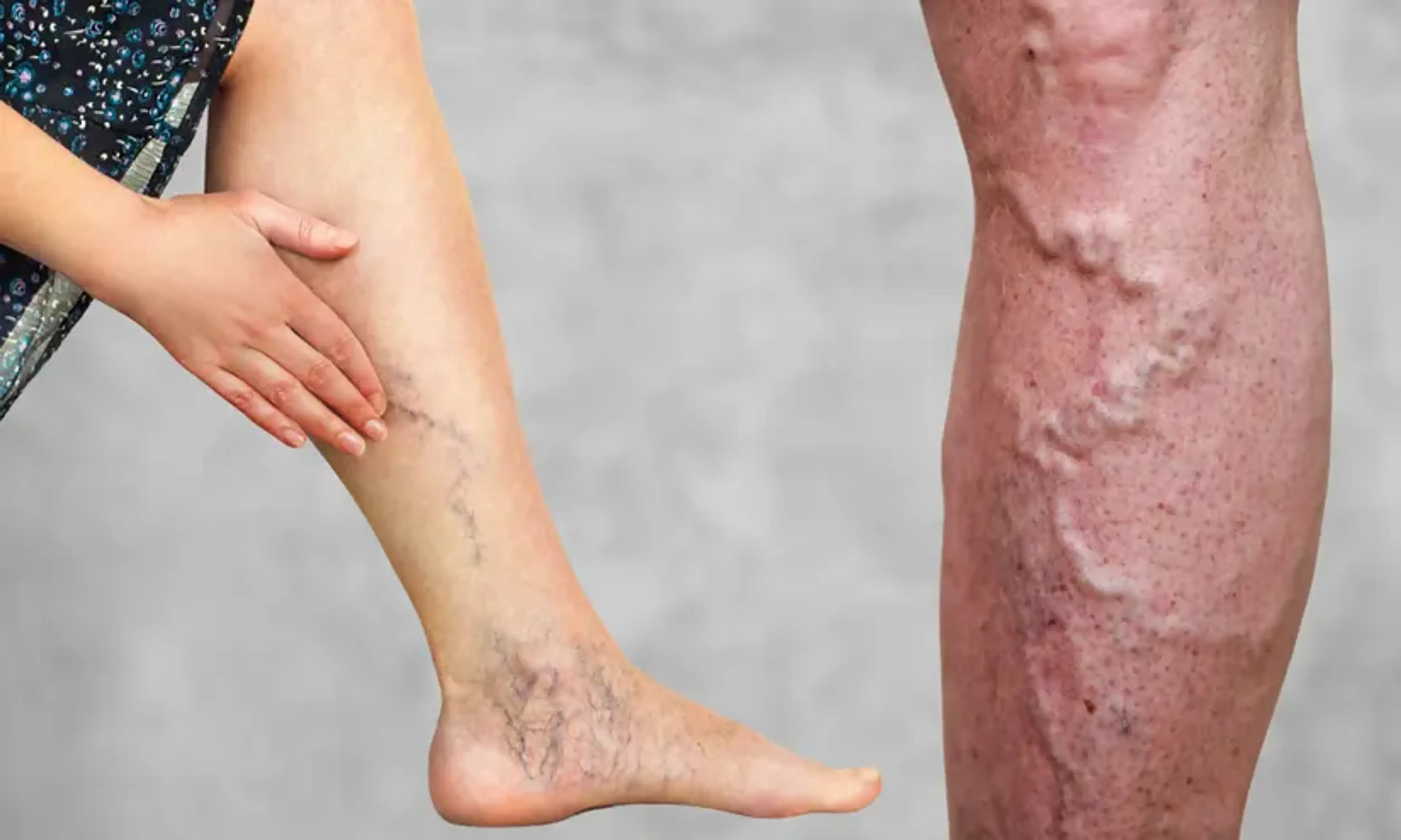 Sclerotherapy