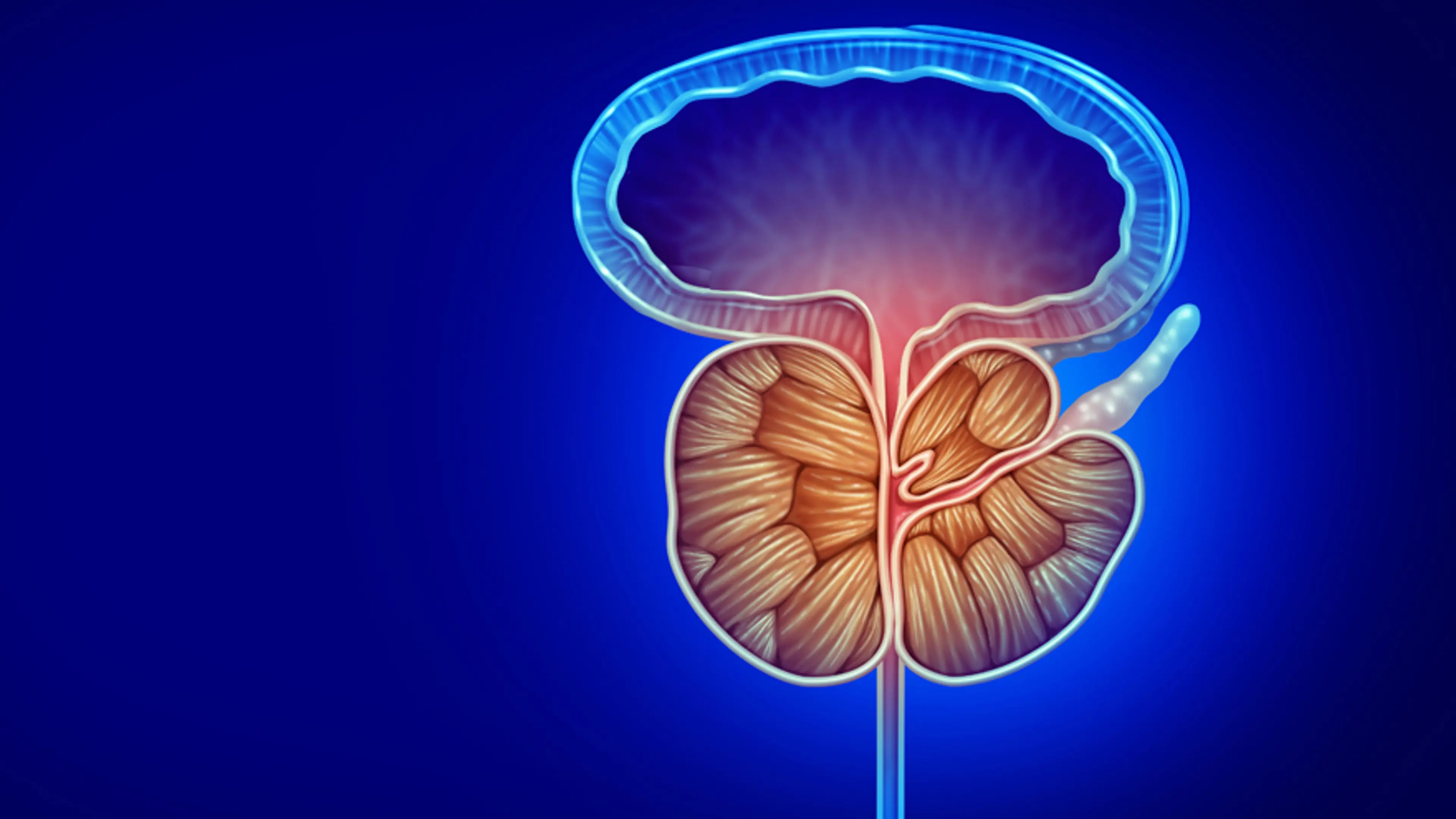 Prostate Enlargement