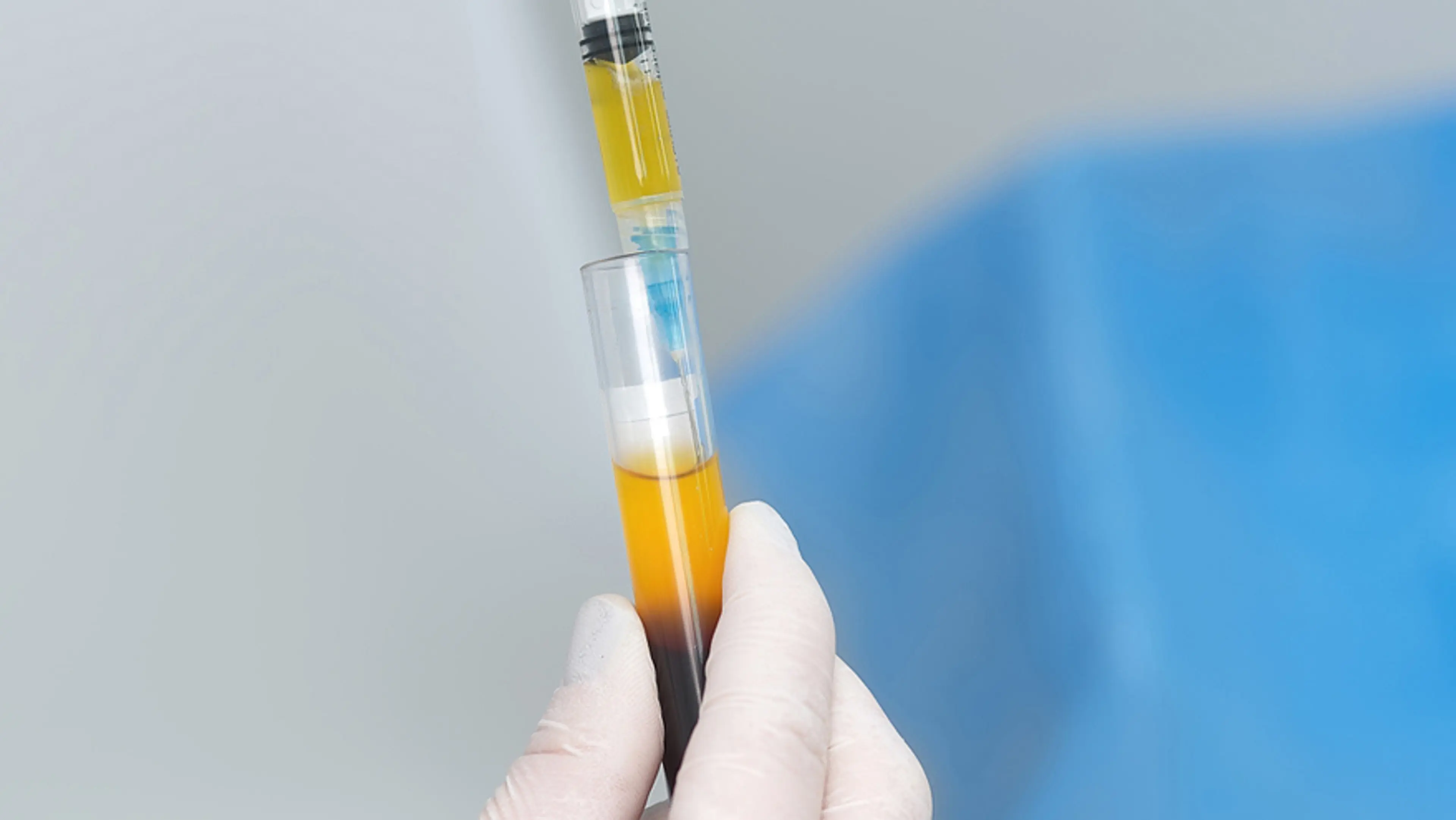 PRP Eye Treatment
