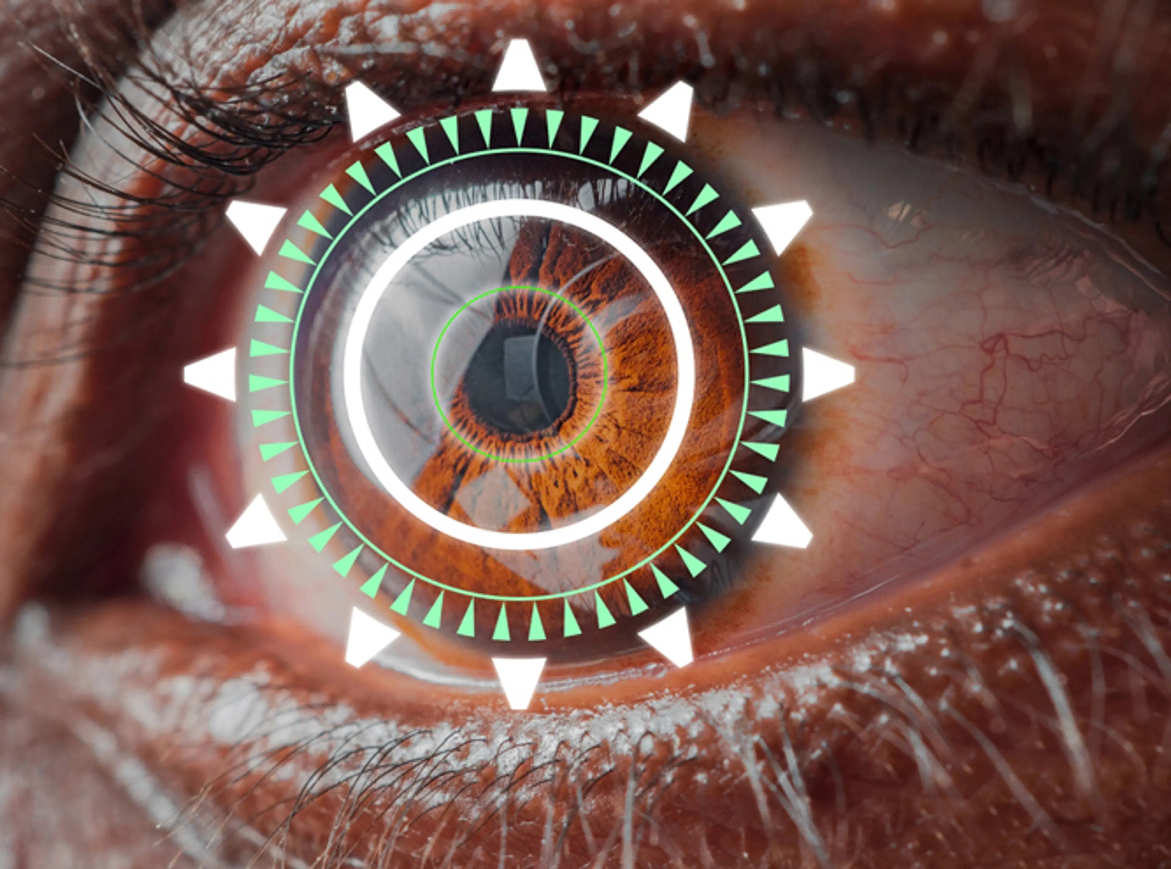 Cataract Surgery