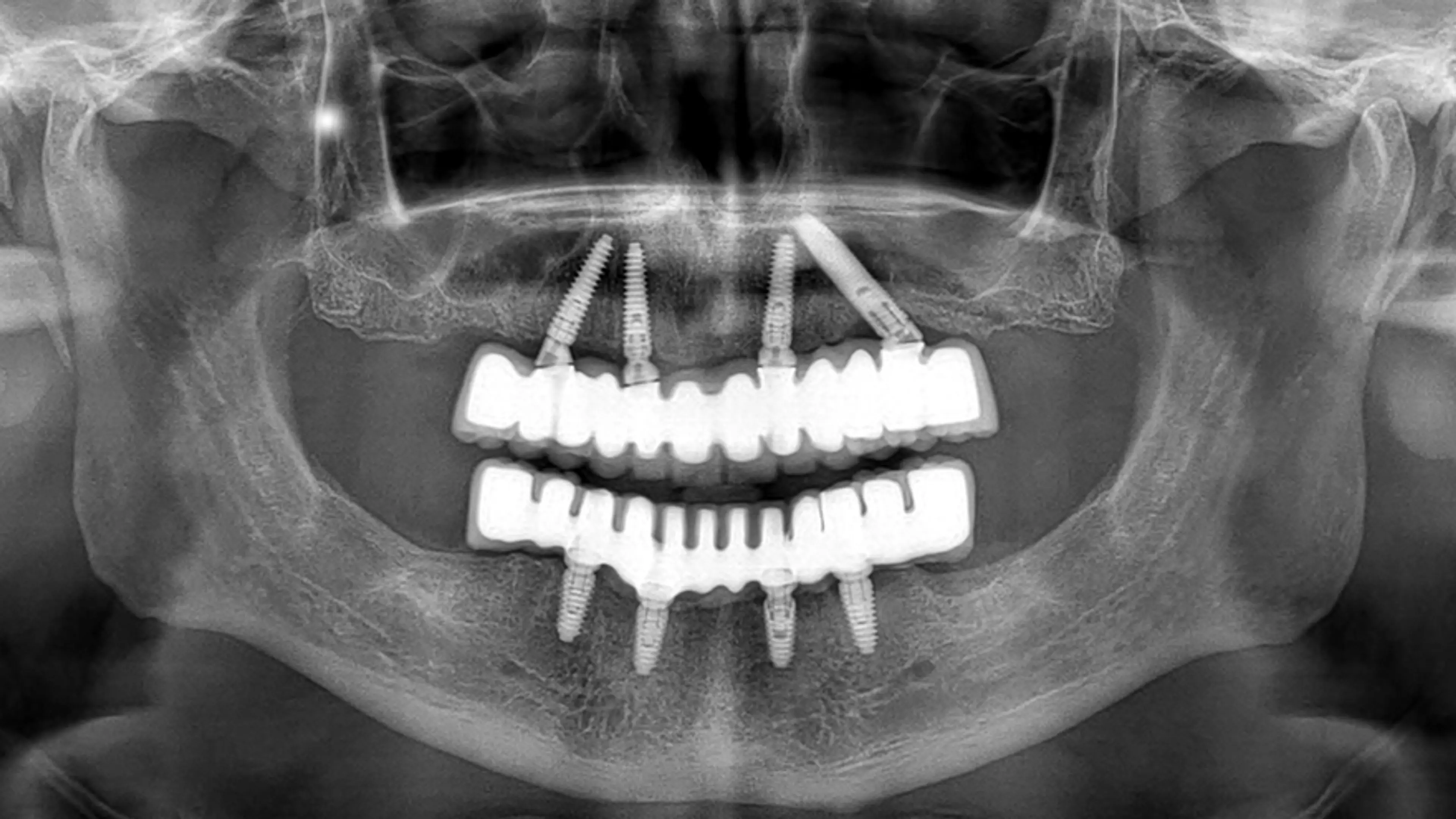 電腦化植入物分析