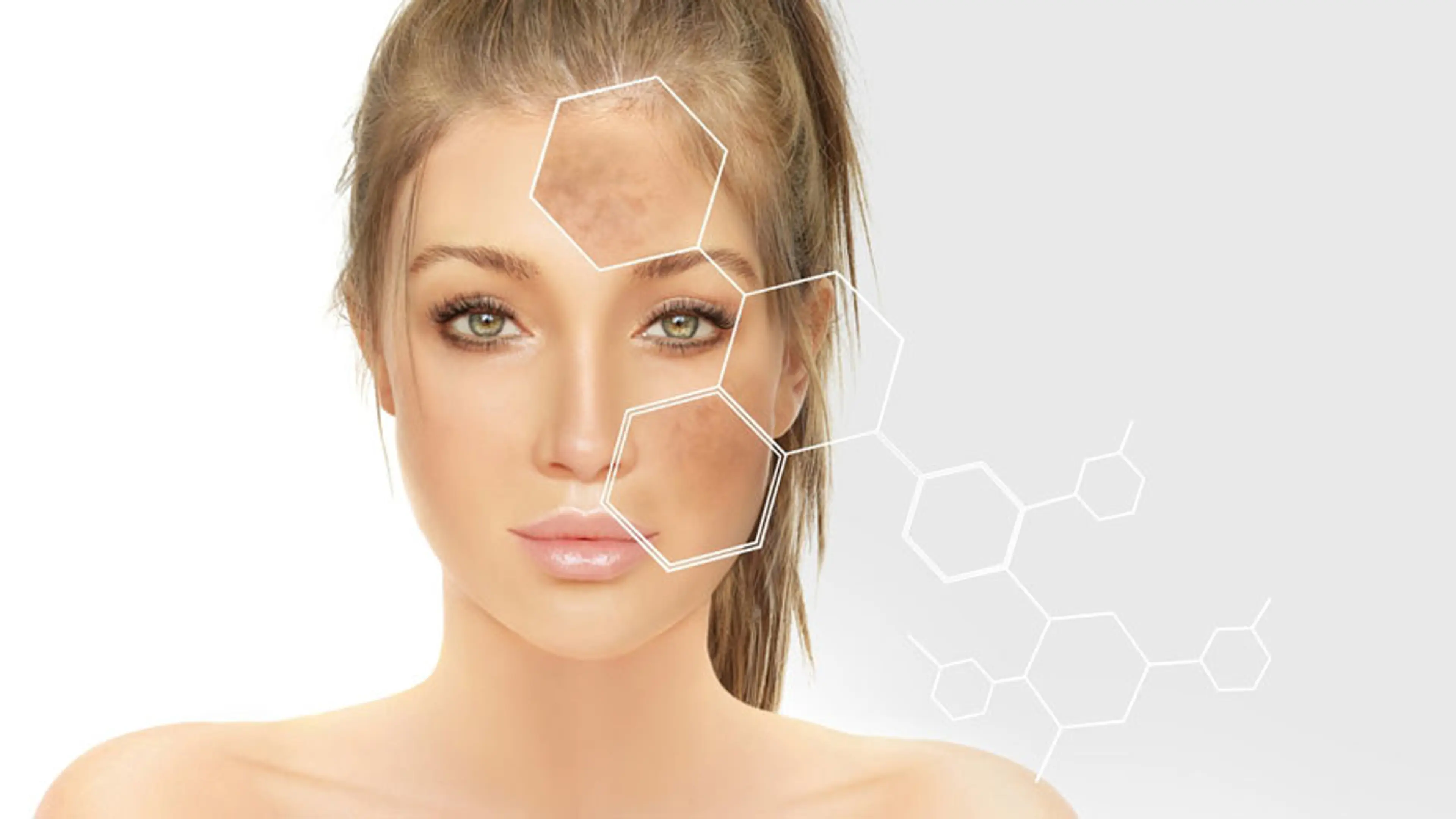 Hyperpigmentation