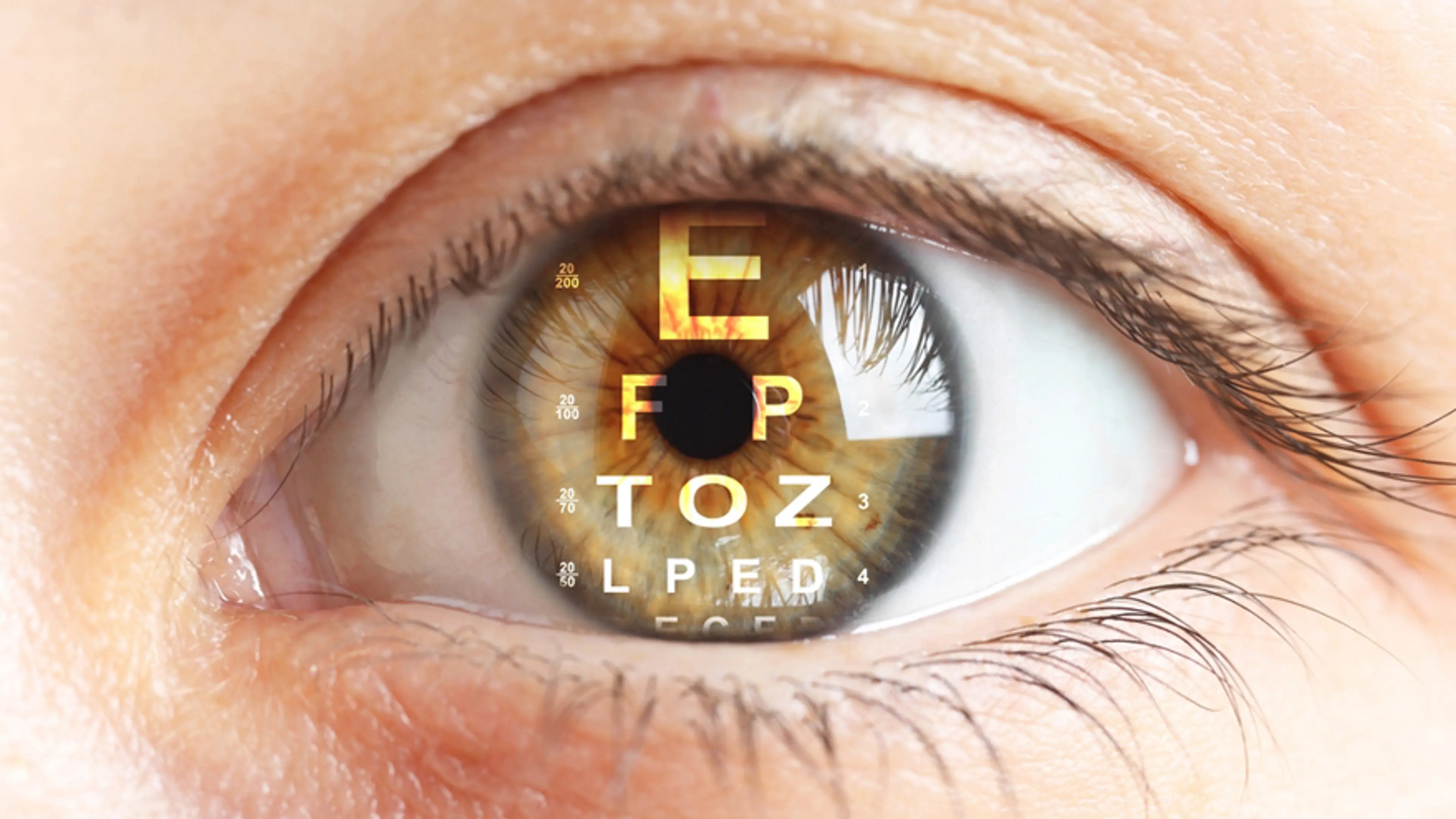 可植入式胶原蛋白晶体（ICL）