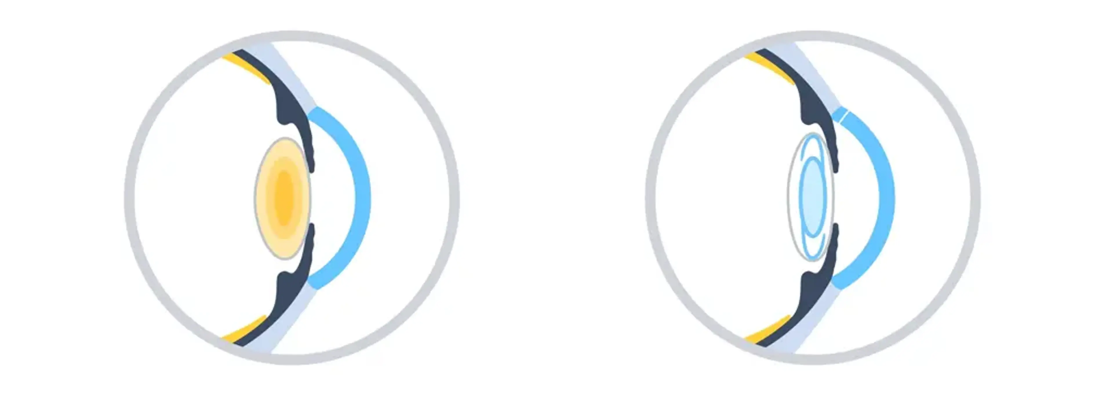 Gangnam Joeunnun Vision Clinic