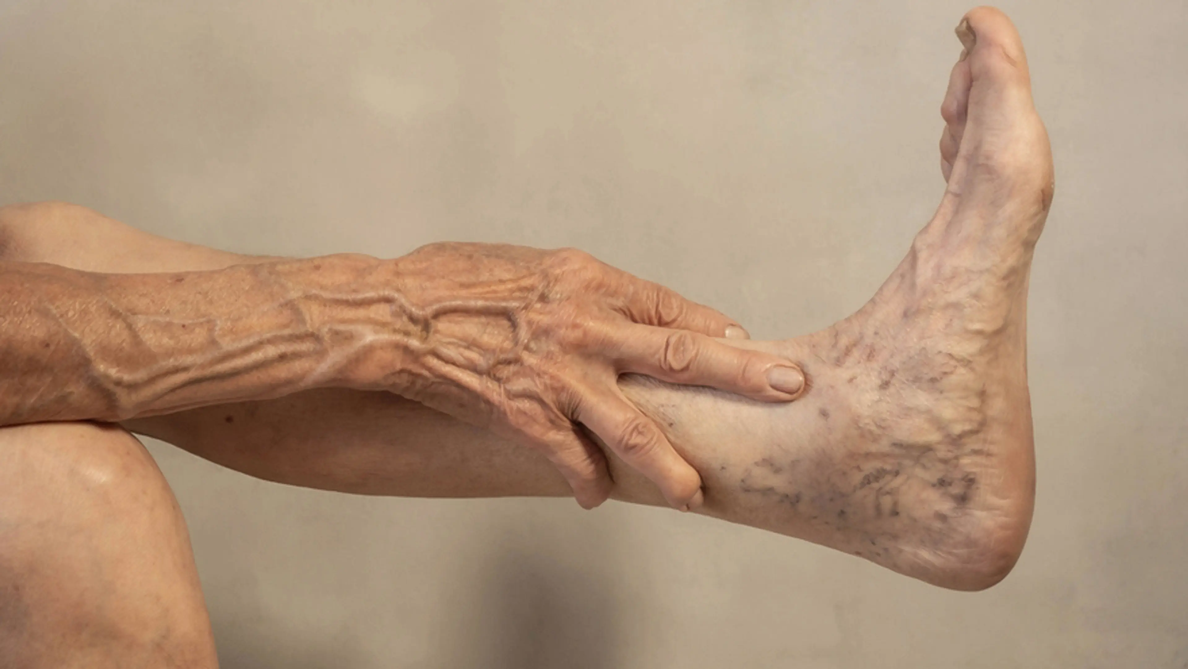 Developing Varicose Veins