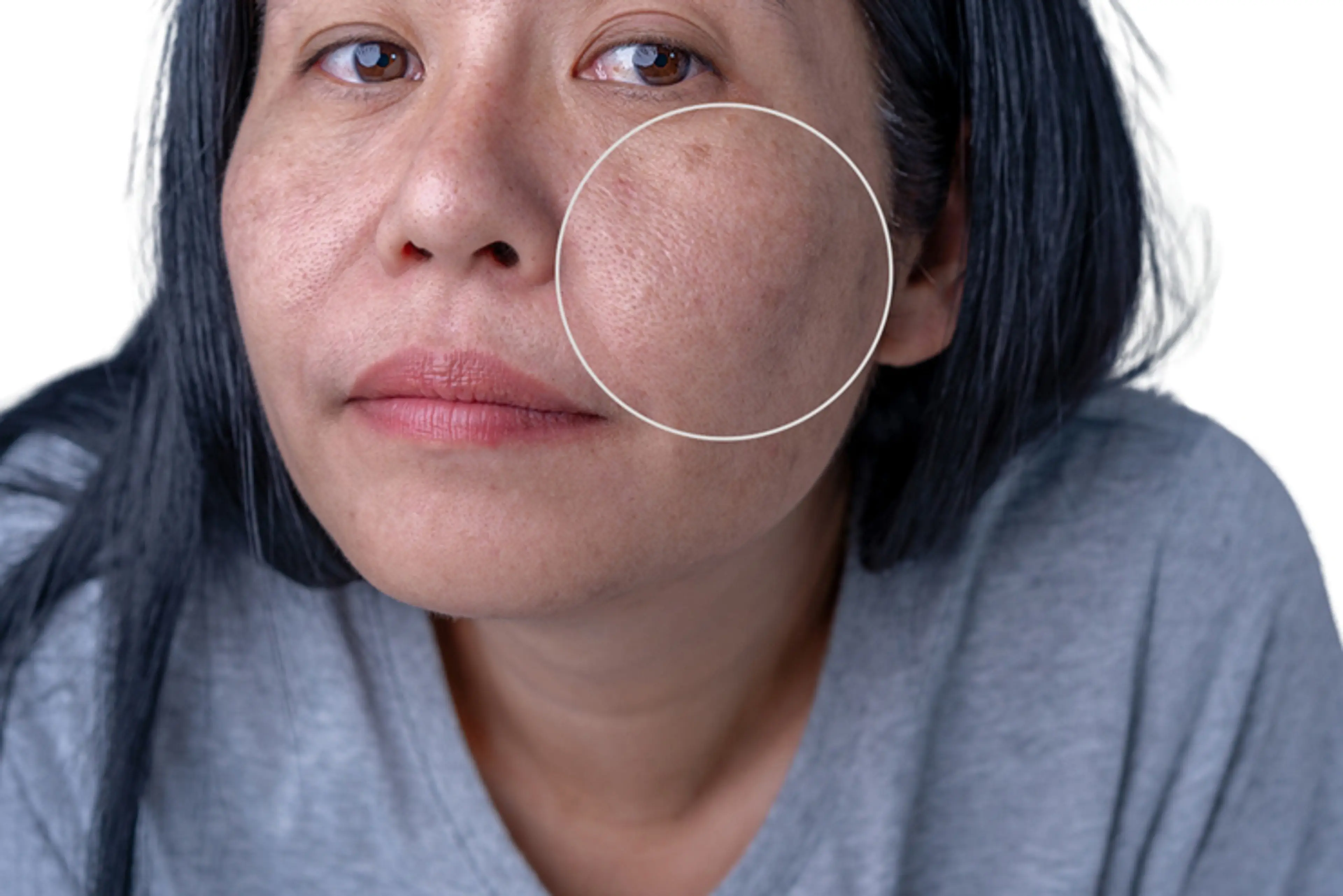 Laser Treatment