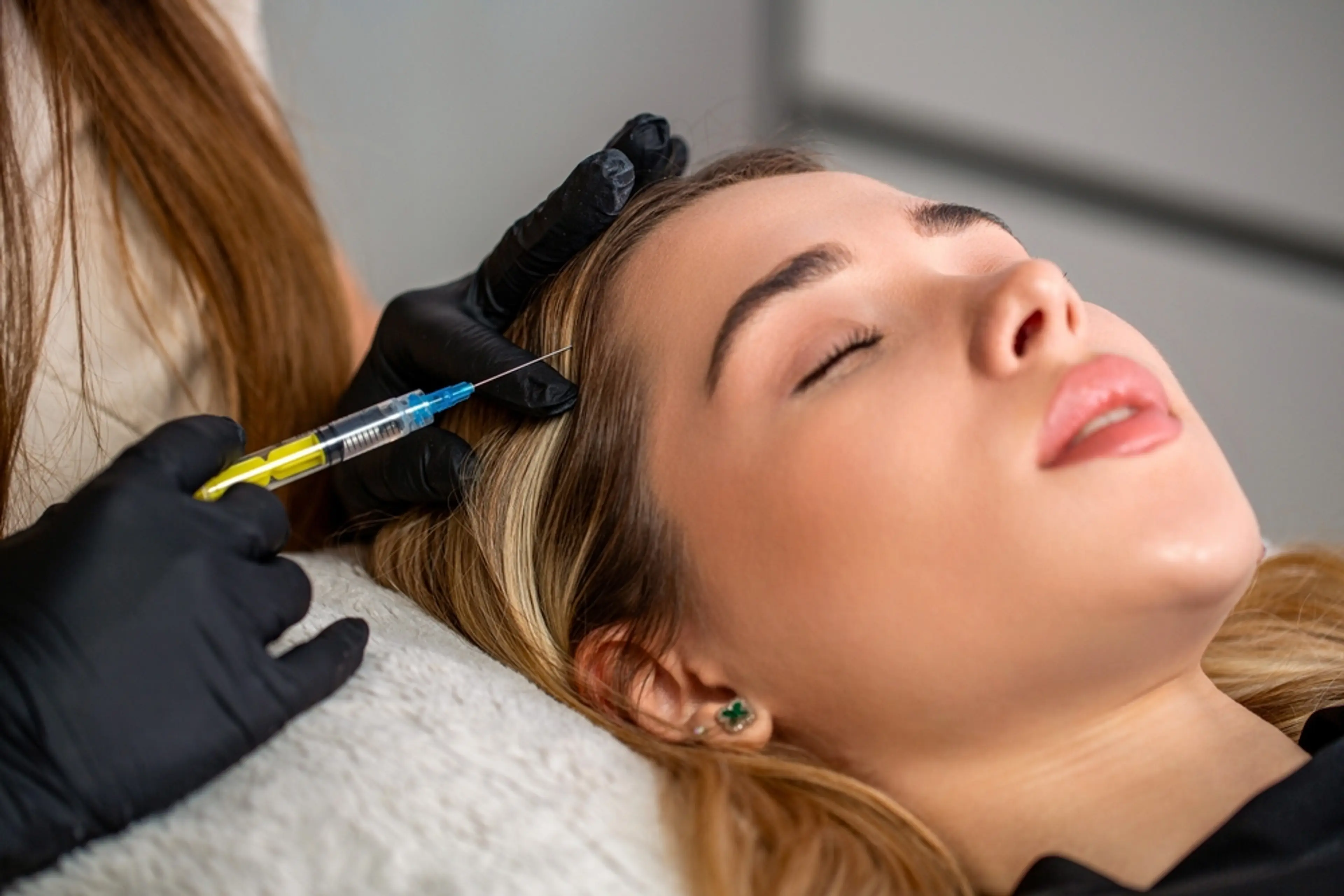 Faktor yang Membuat Terapi Rambut PRP Lebih Efektif dari Waktu ke Waktu