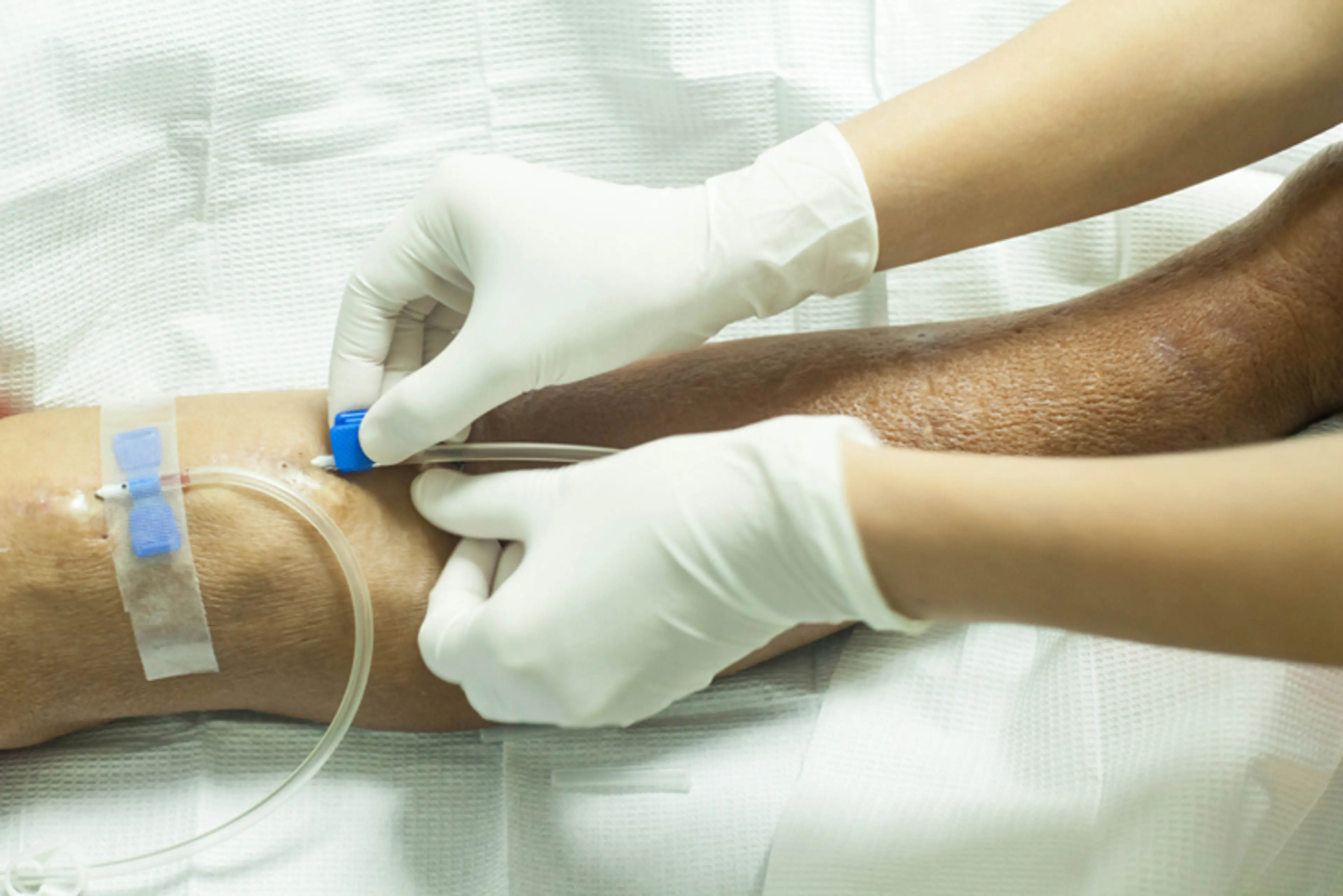Dialysis Access Sites