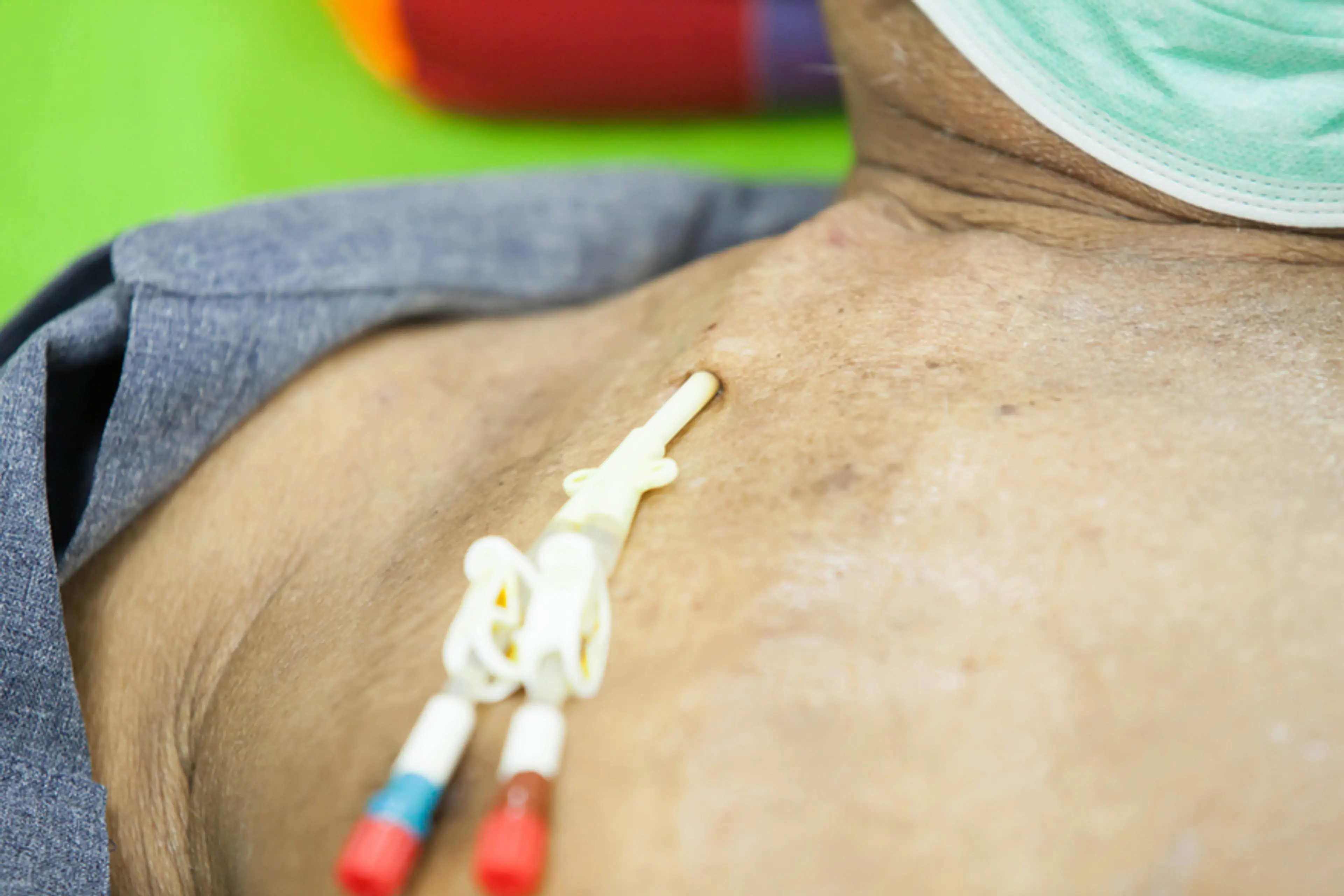 Dialysis Access Surgery