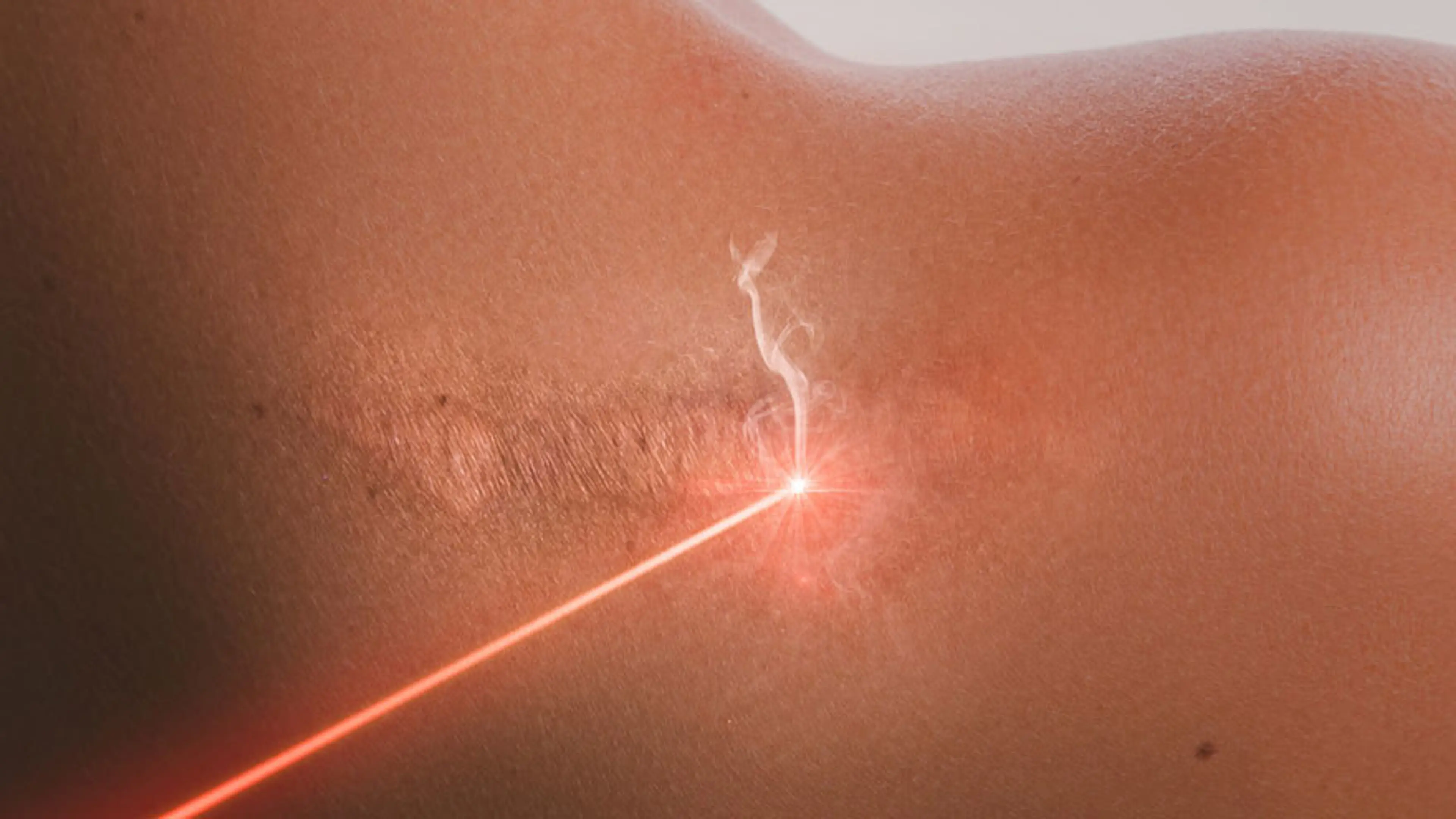 Stem Cell Treatment for Scarring