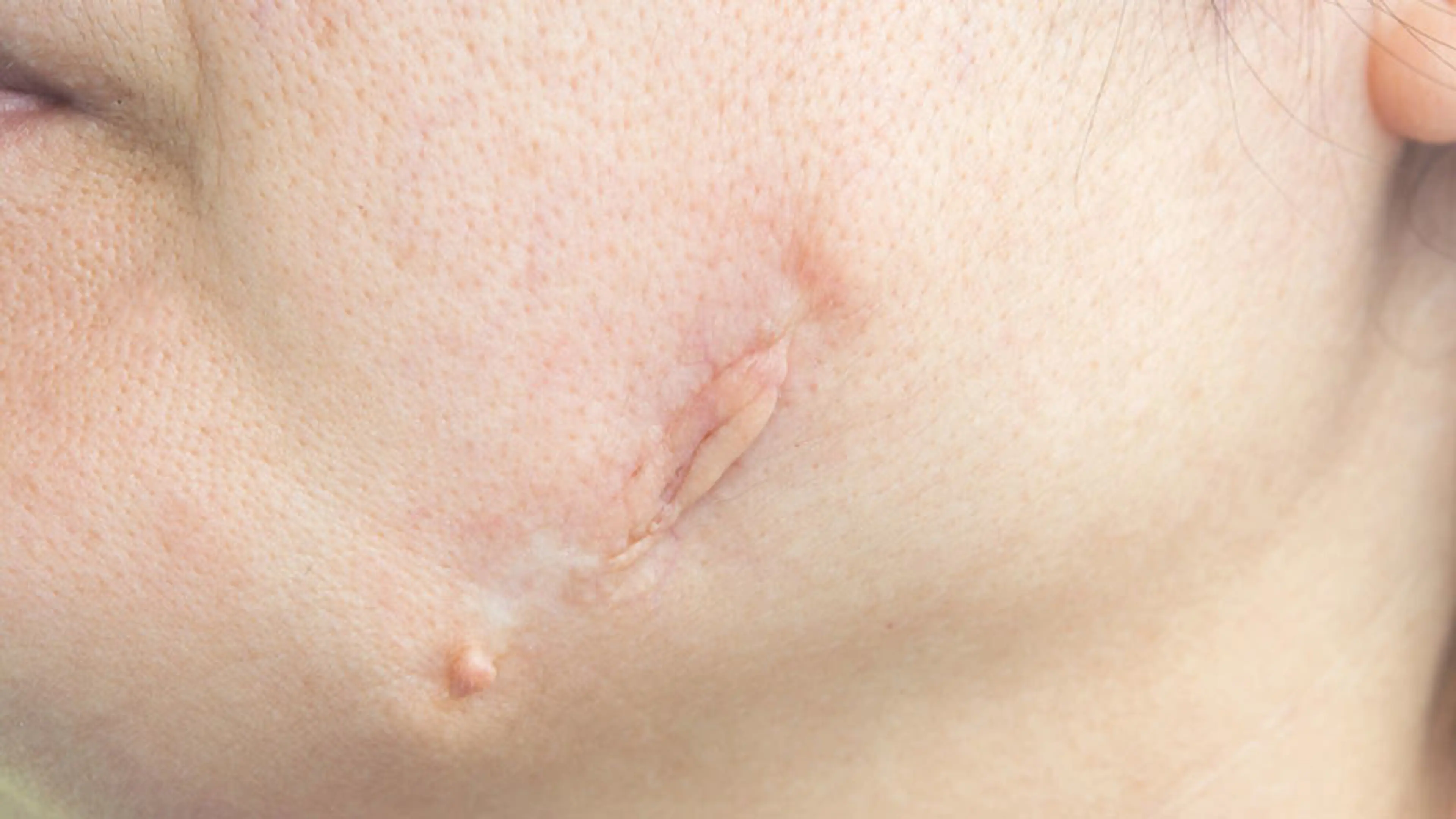 痤疮疤痕难以消除